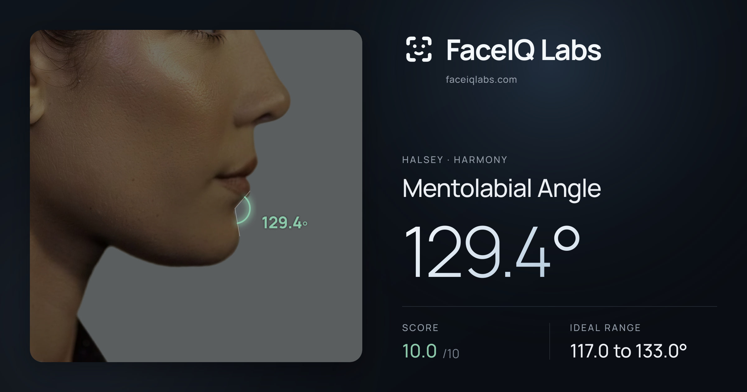 Halsey Mentolabial Angle: 129.4°, drawn on the photo