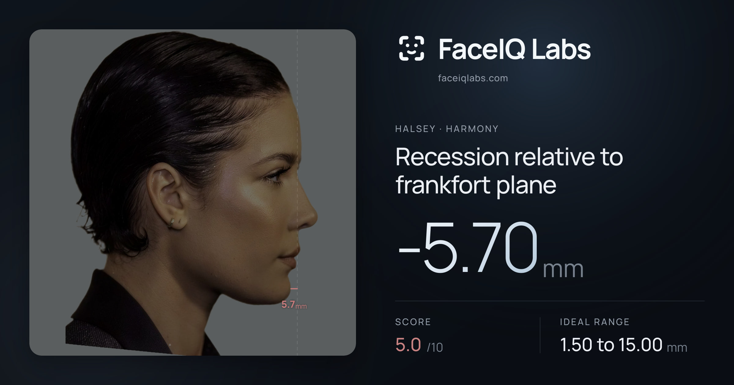 Halsey Recession relative to frankfort plane: -5.70mm, drawn on the photo