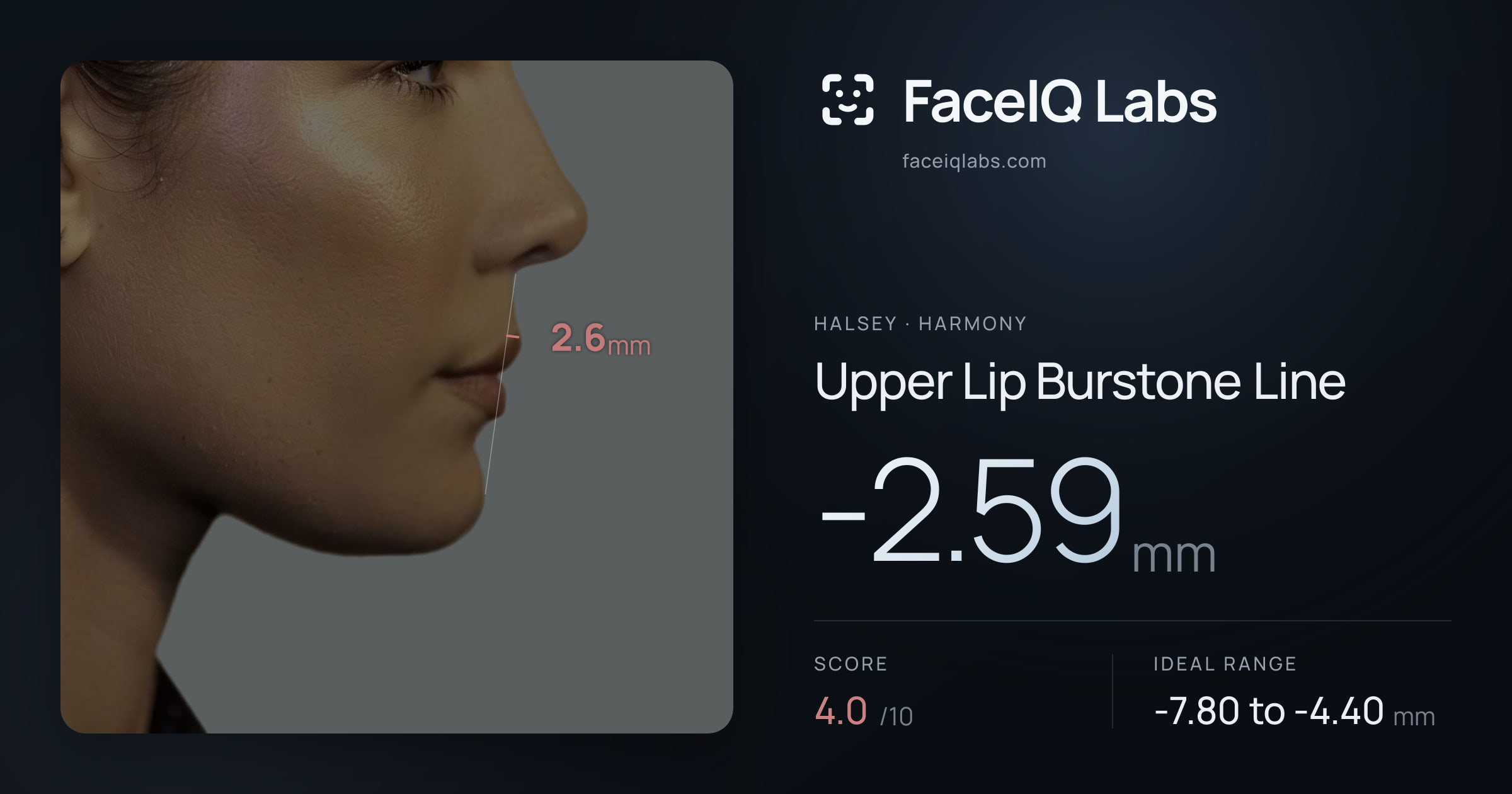 Halsey Upper Lip Burstone Line: -2.59mm, drawn on the photo