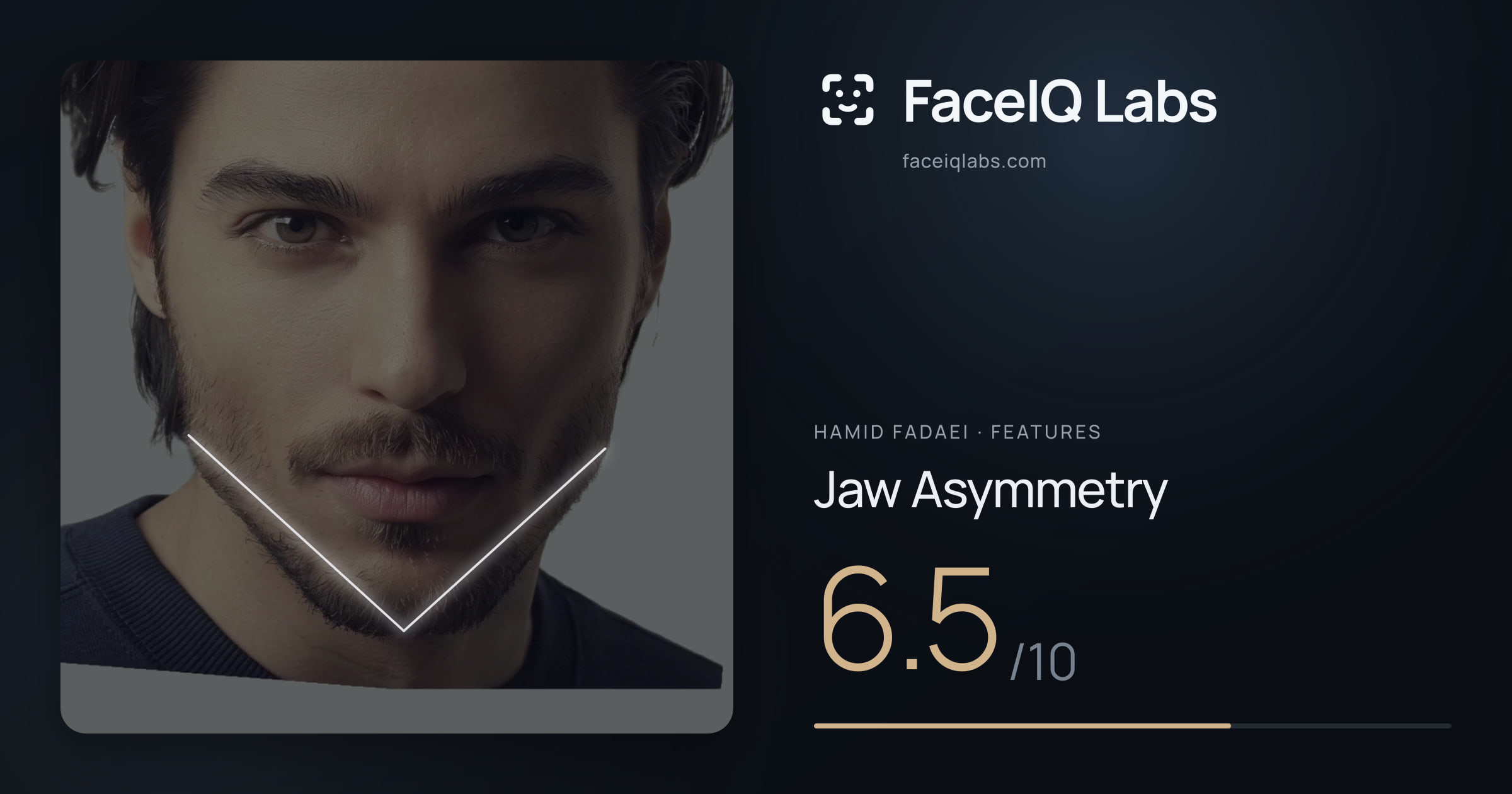 Hamid Fadaei Jaw Asymmetry: 6.5/10, drawn on the photo