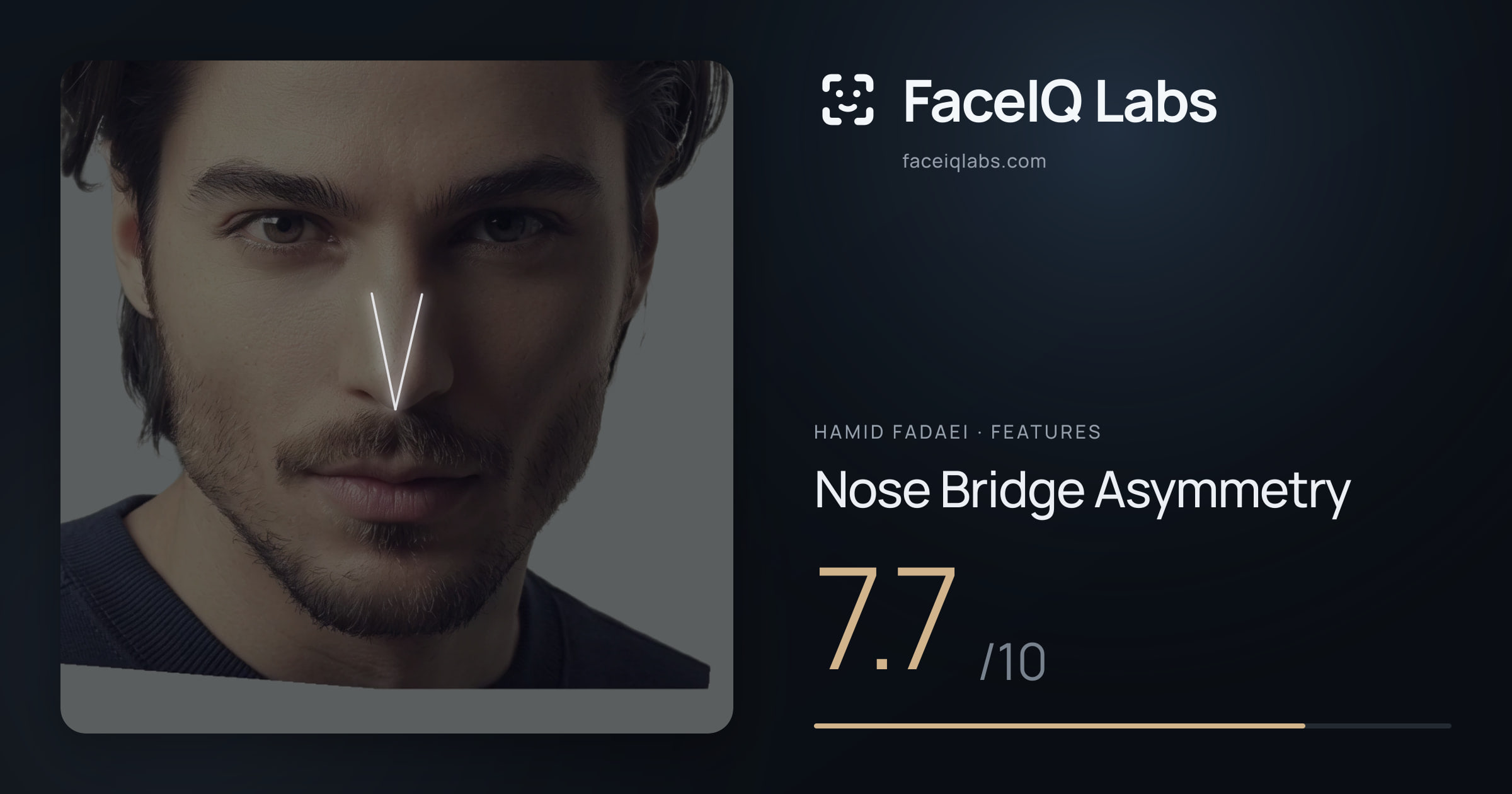 Hamid Fadaei Nose Bridge Asymmetry: 7.7/10, drawn on the photo