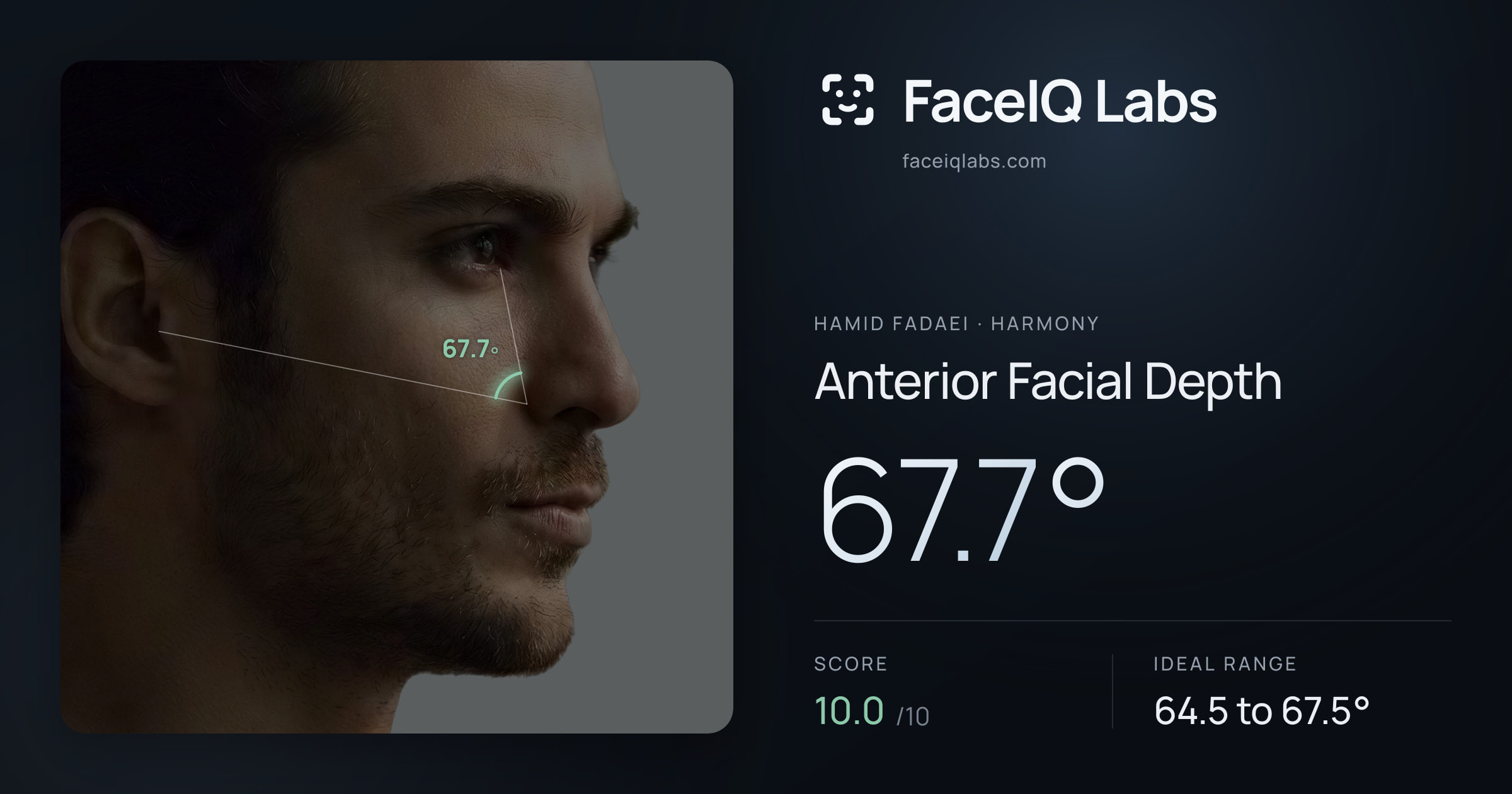 Hamid Fadaei Anterior Facial Depth: 67.7°, drawn on the photo