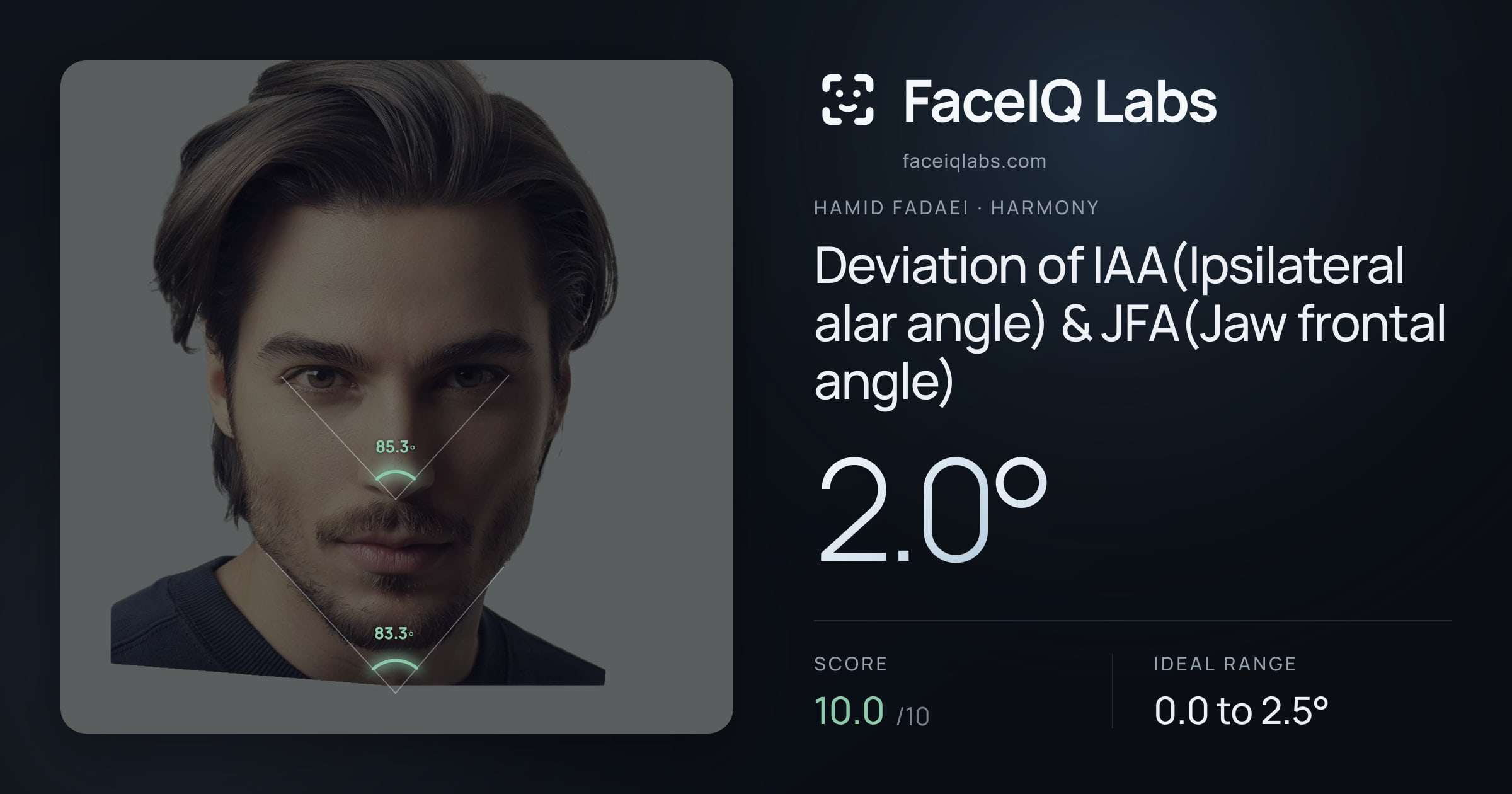 Hamid Fadaei Deviation of IAA(Ipsilateral alar angle) & JFA(Jaw frontal angle): 2.0°, drawn on the photo