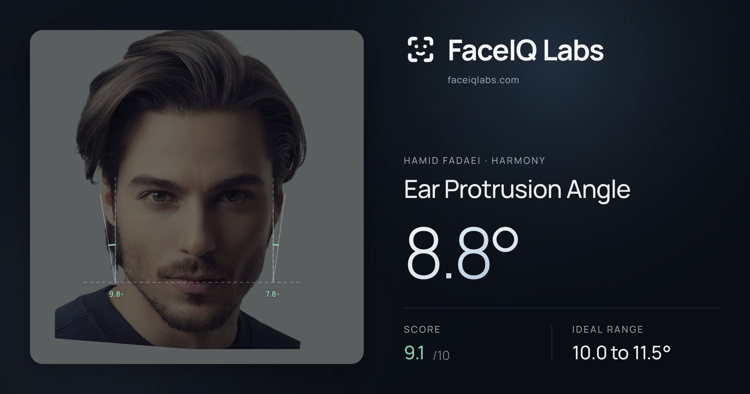 Hamid Fadaei Ear Protrusion Angle: 8.8°, drawn on the photo