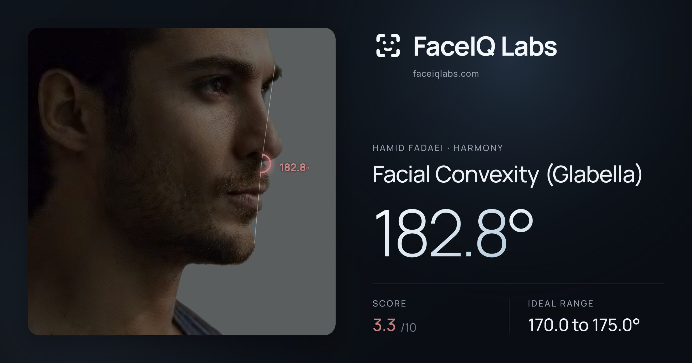Hamid Fadaei Facial Convexity (Glabella): 182.8°, drawn on the photo