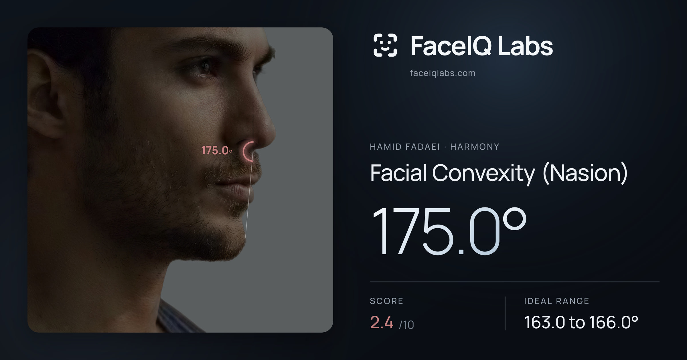 Hamid Fadaei Facial Convexity (Nasion): 175.0°, drawn on the photo
