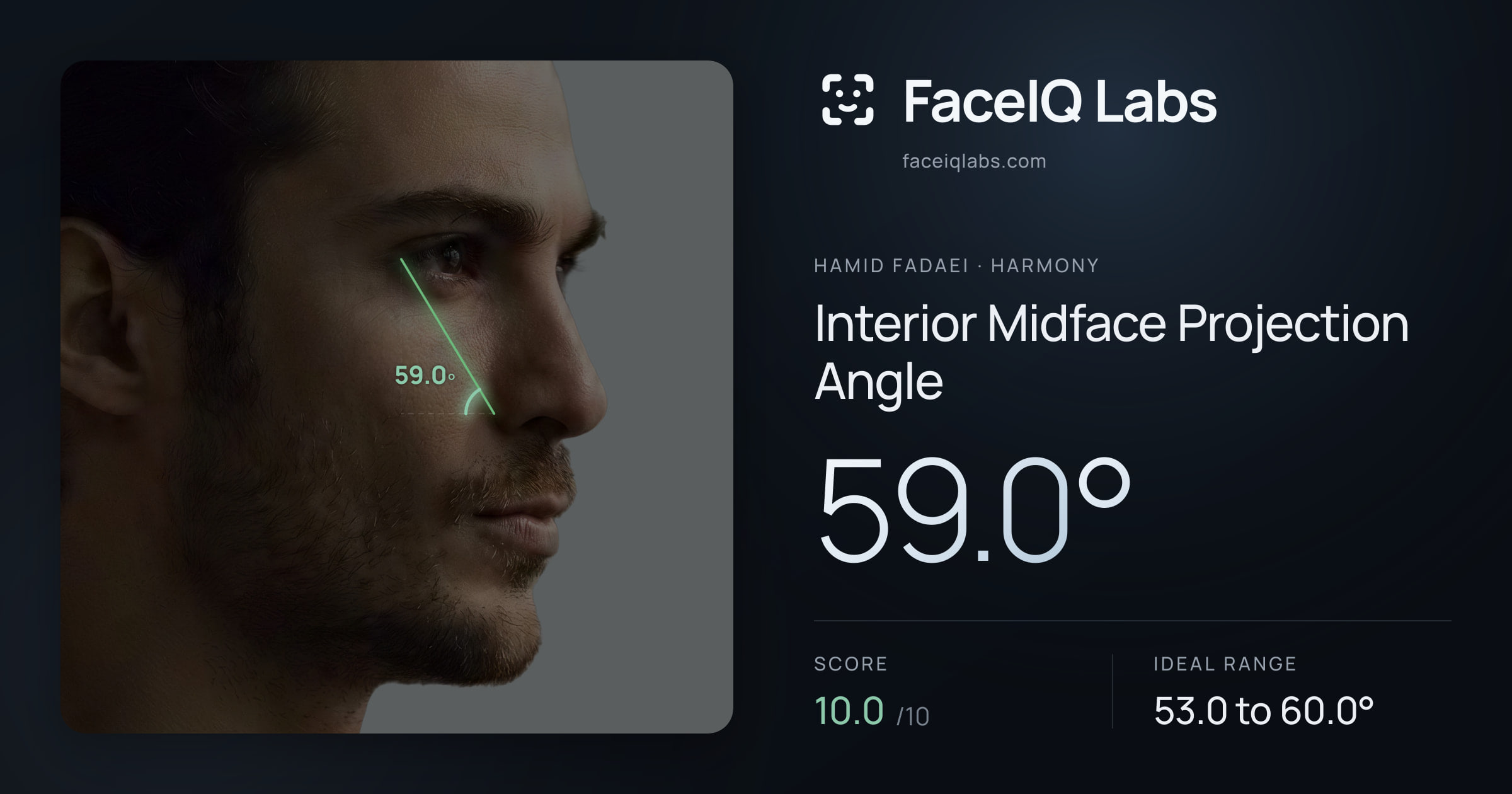 Hamid Fadaei Interior Midface Projection Angle: 59.0°, drawn on the photo