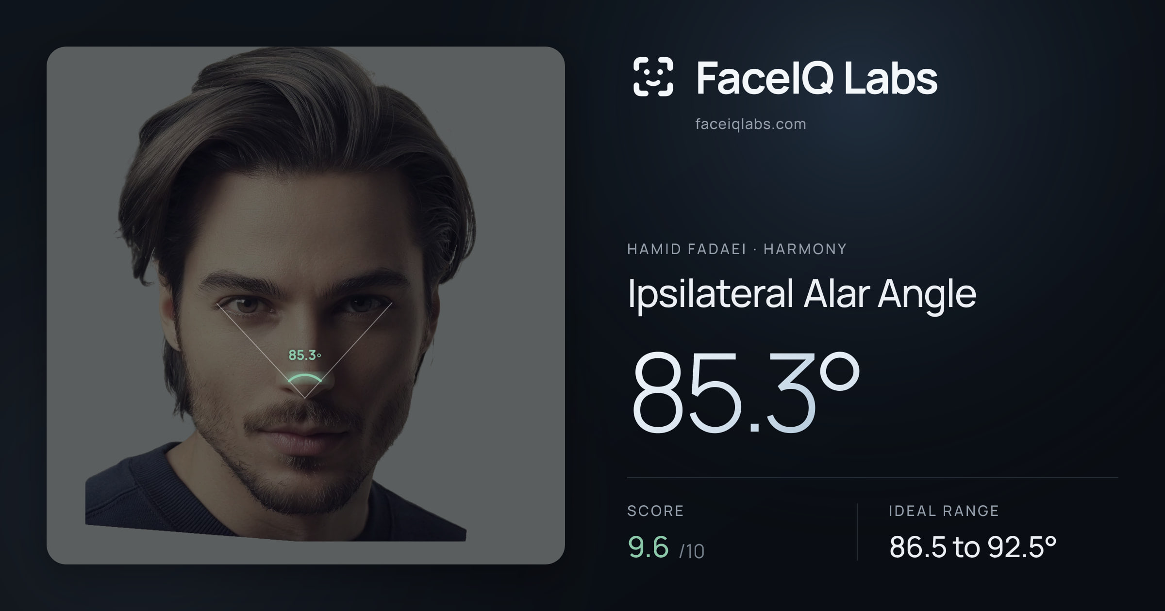 Hamid Fadaei Ipsilateral Alar Angle: 85.3°, drawn on the photo