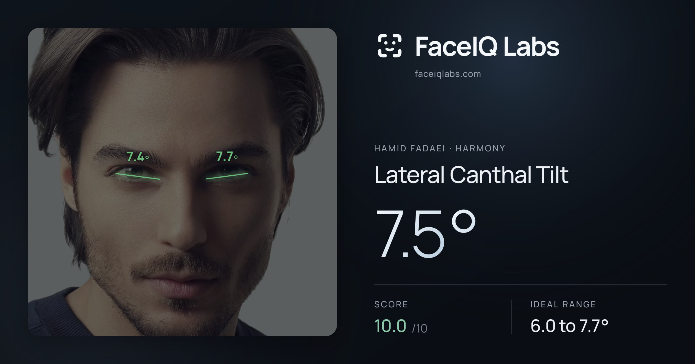 Hamid Fadaei Lateral Canthal Tilt: 7.5°, drawn on the photo