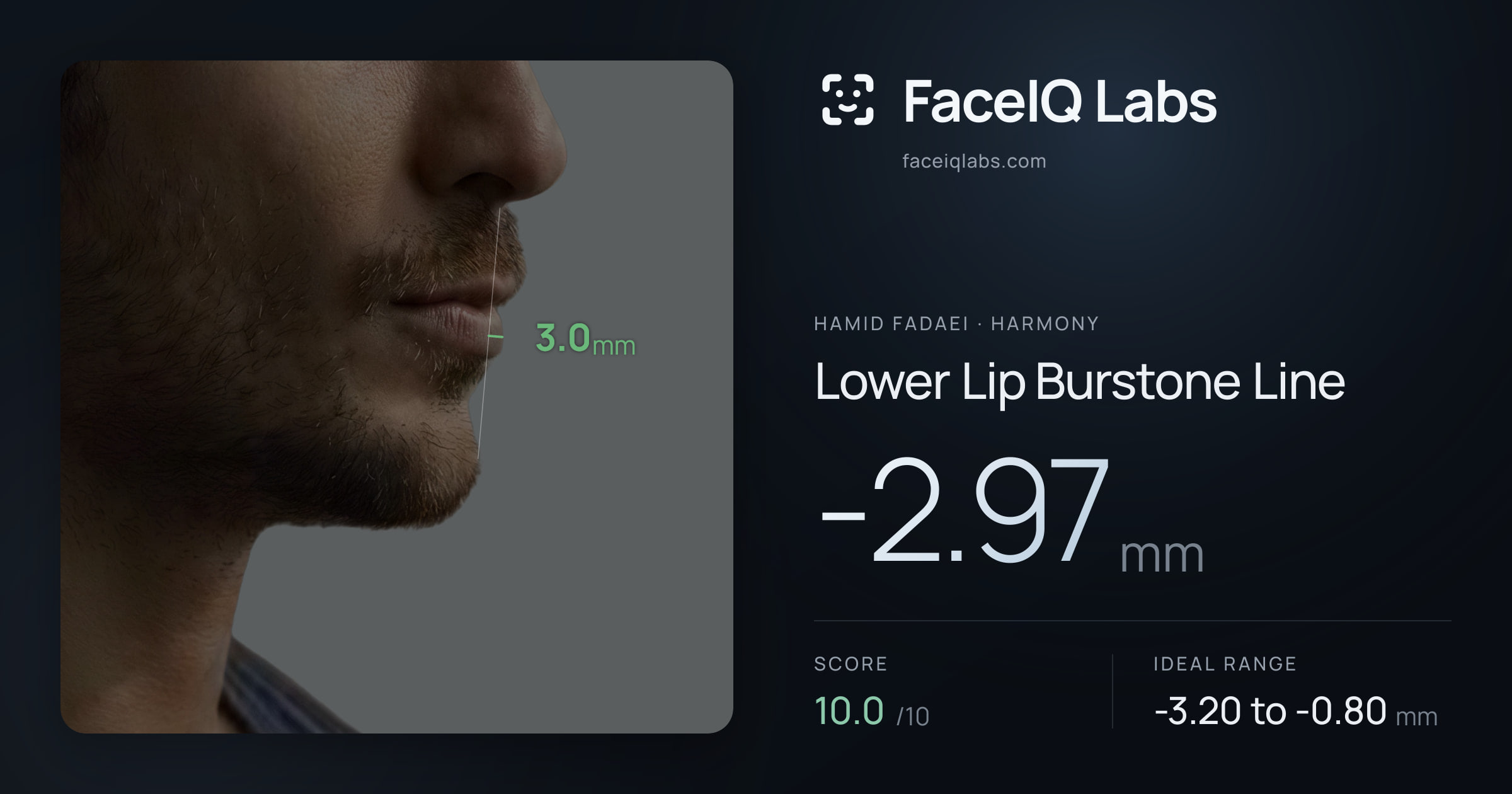 Hamid Fadaei Lower Lip Burstone Line: -2.97mm, drawn on the photo