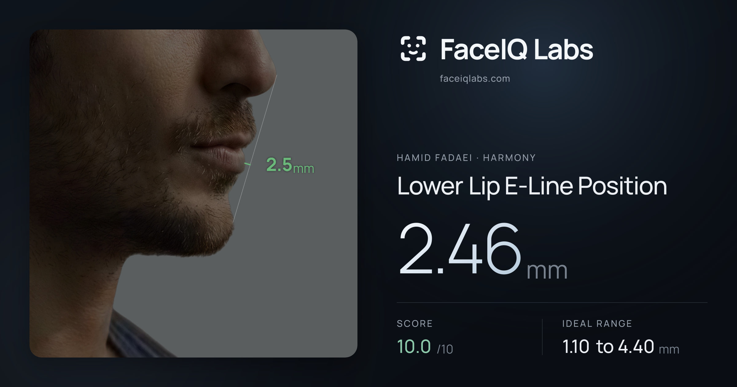 Hamid Fadaei Lower Lip E-Line Position: 2.46mm, drawn on the photo