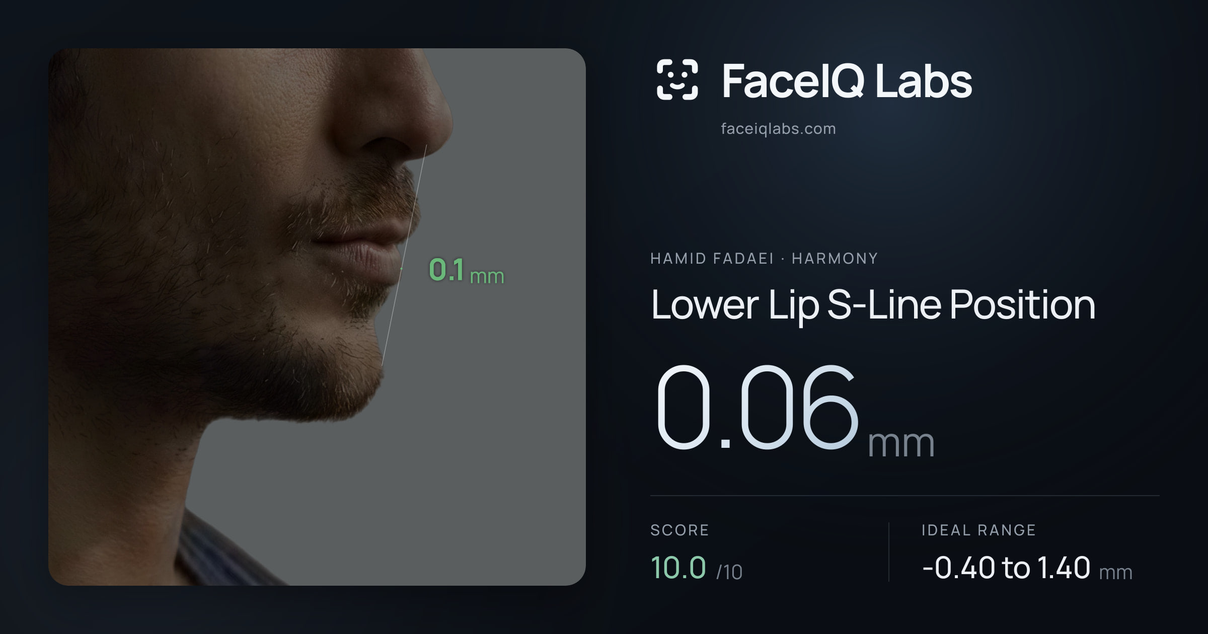 Hamid Fadaei Lower Lip S-Line Position: 0.06mm, drawn on the photo