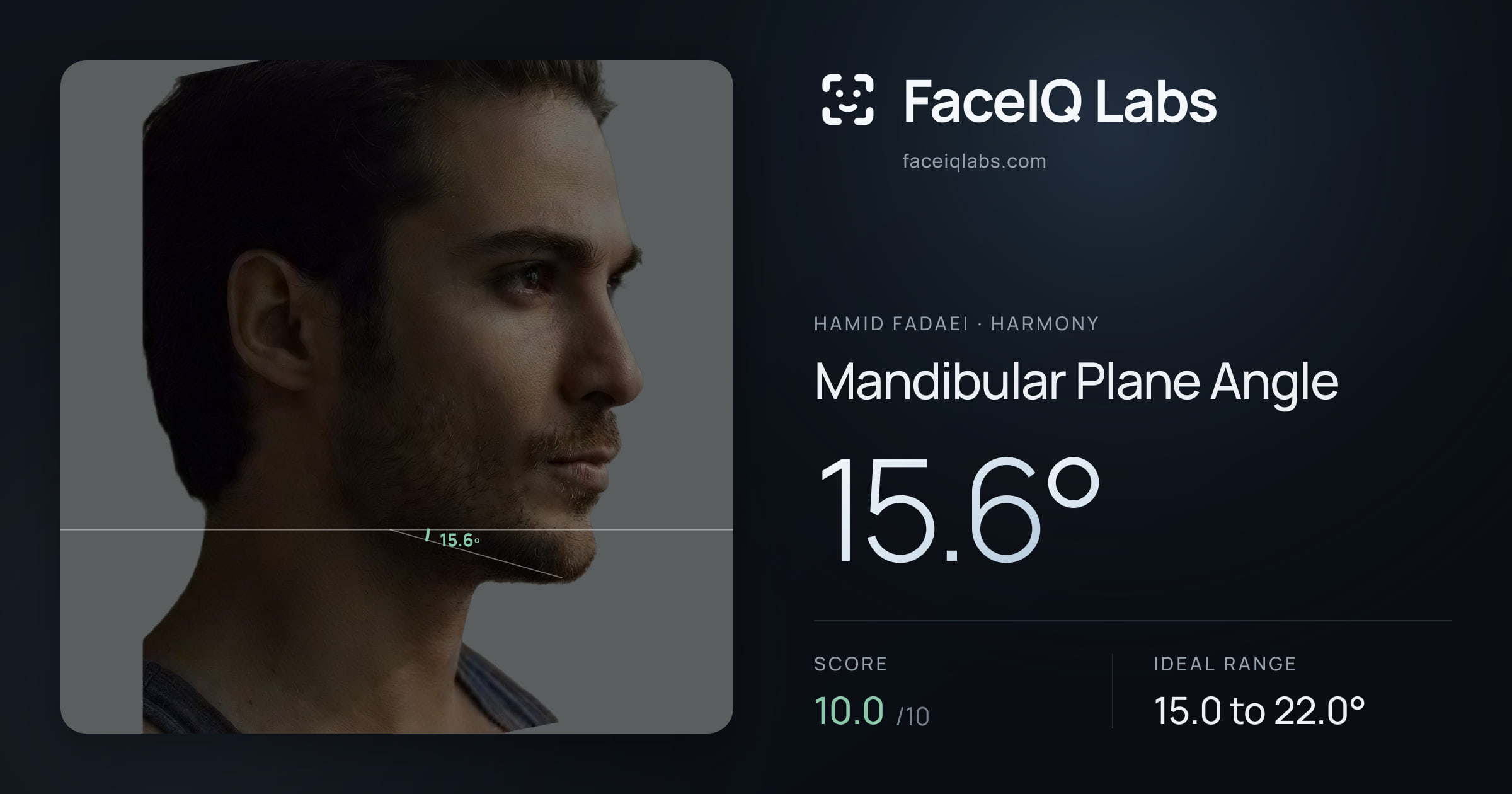 Hamid Fadaei Mandibular Plane Angle: 15.6°, drawn on the photo