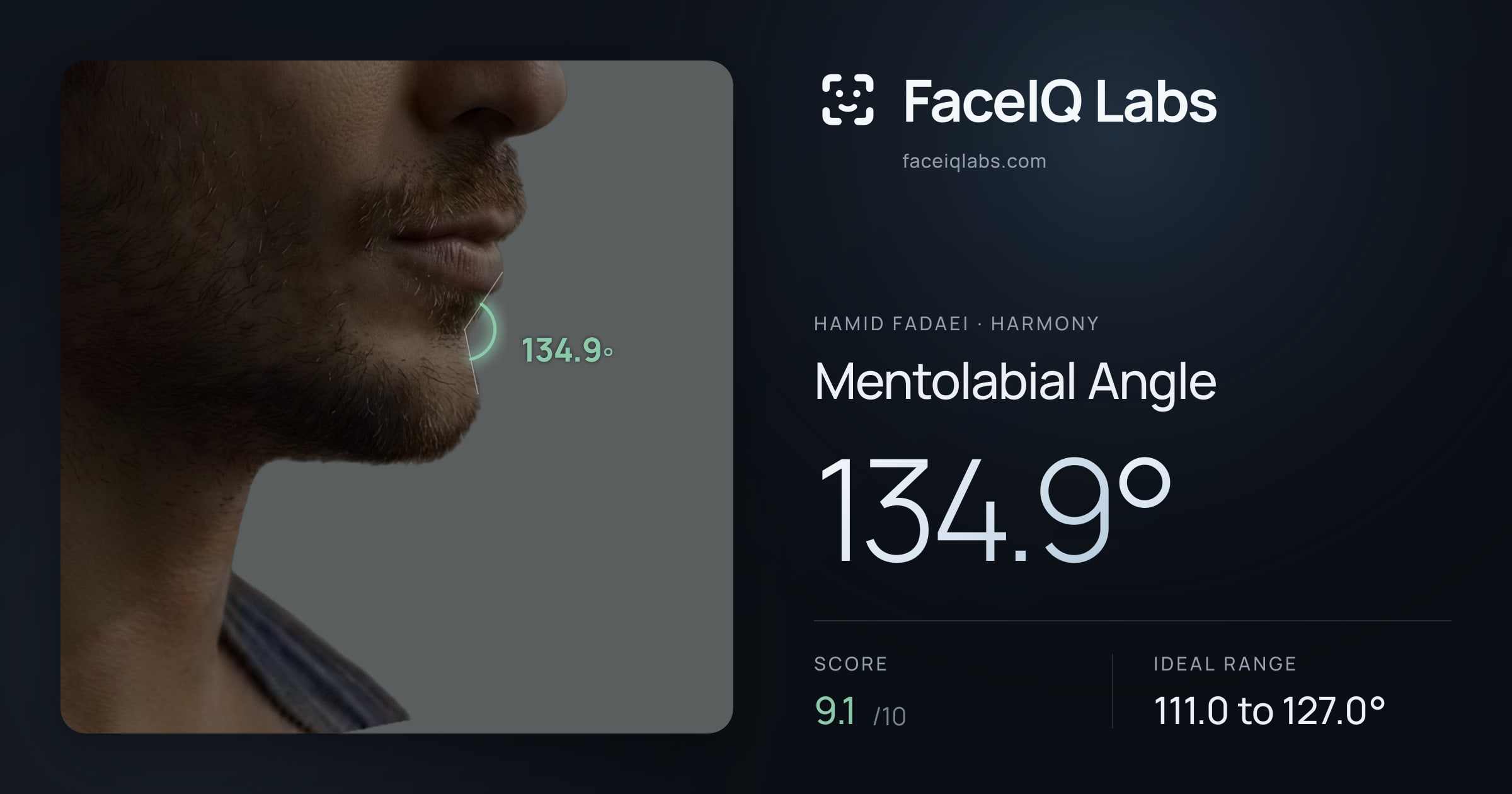 Hamid Fadaei Mentolabial Angle: 134.9°, drawn on the photo