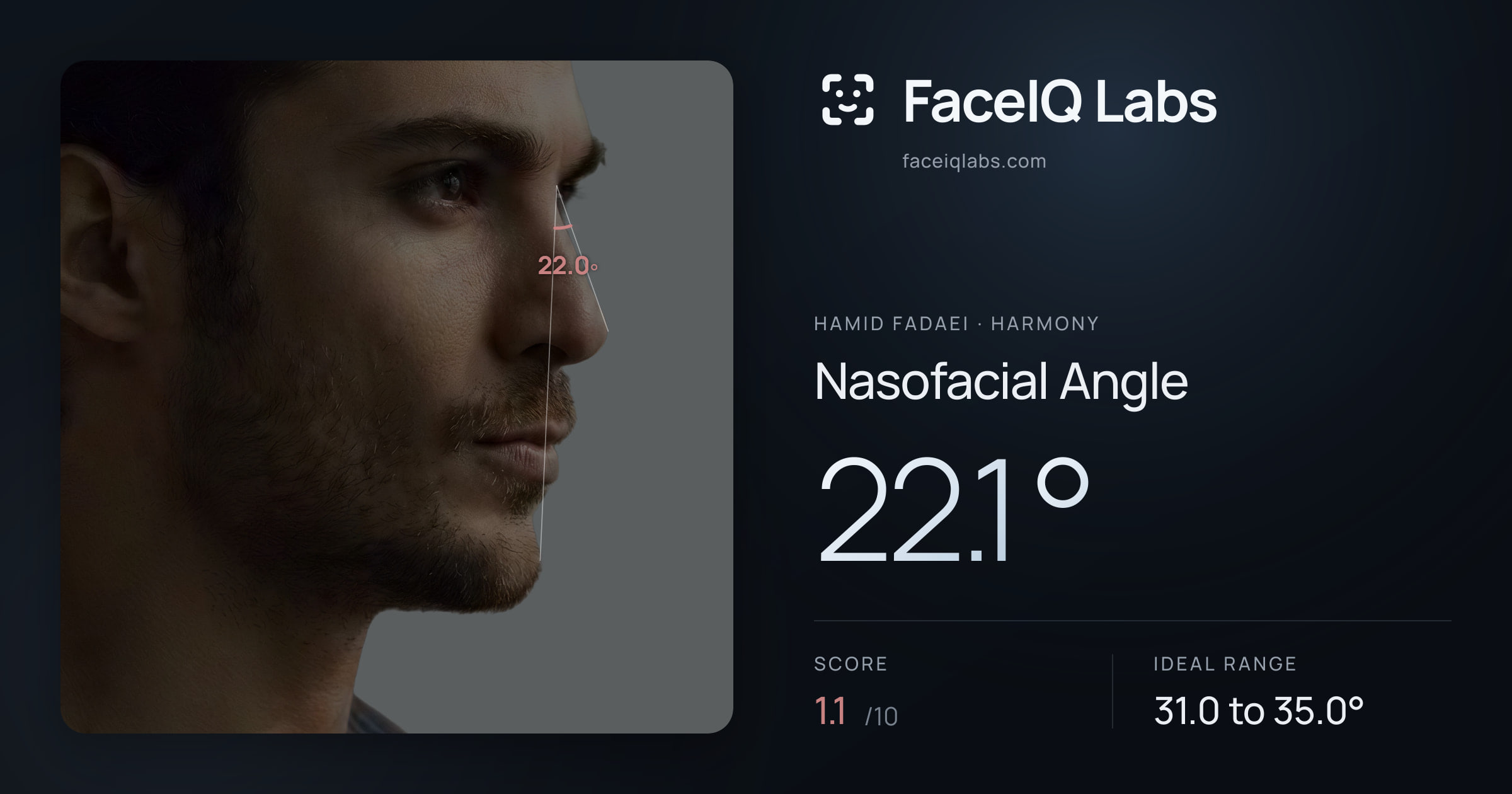 Hamid Fadaei Nasofacial Angle: 22.1°, drawn on the photo