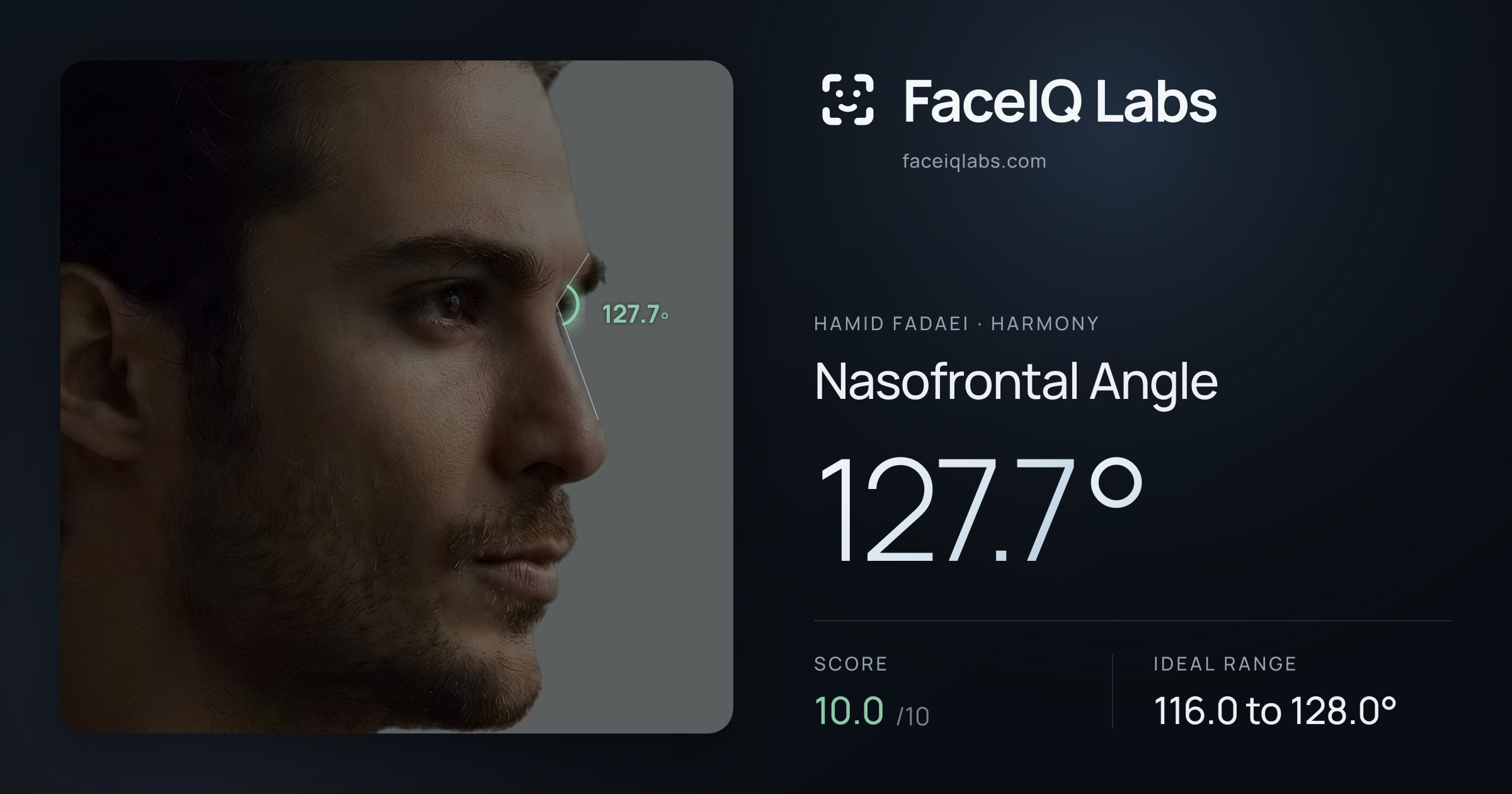 Hamid Fadaei Nasofrontal Angle: 127.7°, drawn on the photo