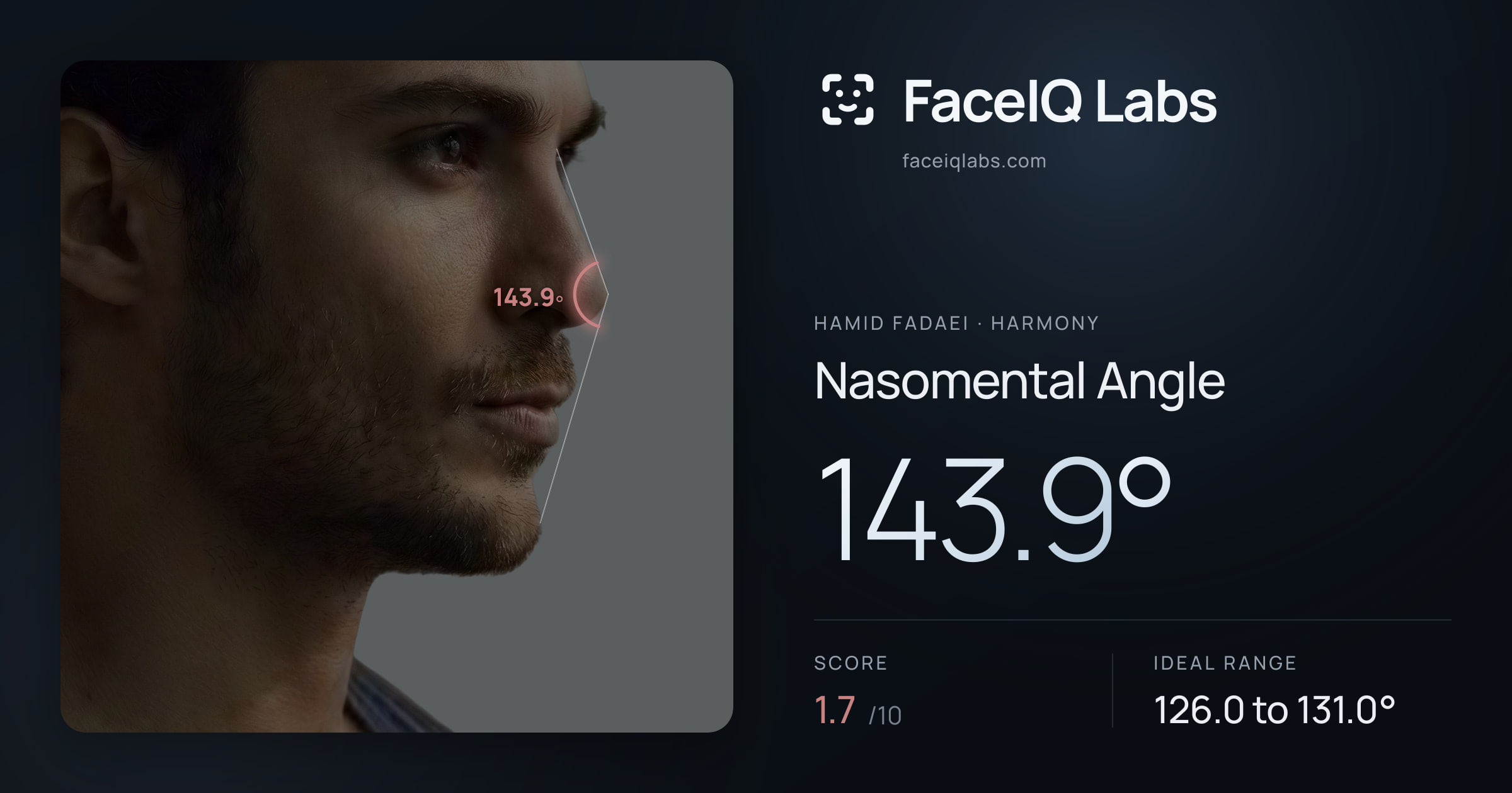 Hamid Fadaei Nasomental Angle: 143.9°, drawn on the photo