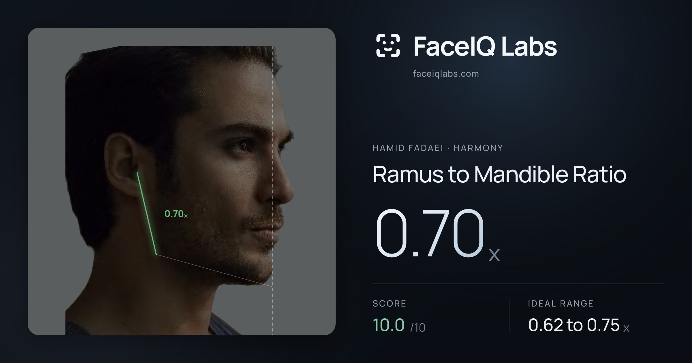 Hamid Fadaei Ramus to Mandible Ratio: 0.70x, drawn on the photo