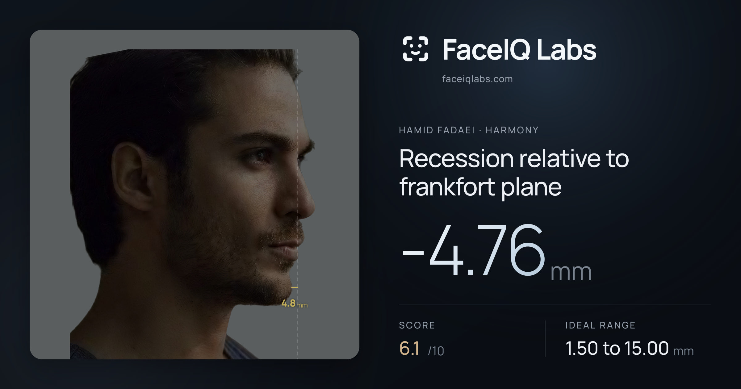 Hamid Fadaei Recession relative to frankfort plane: -4.76mm, drawn on the photo