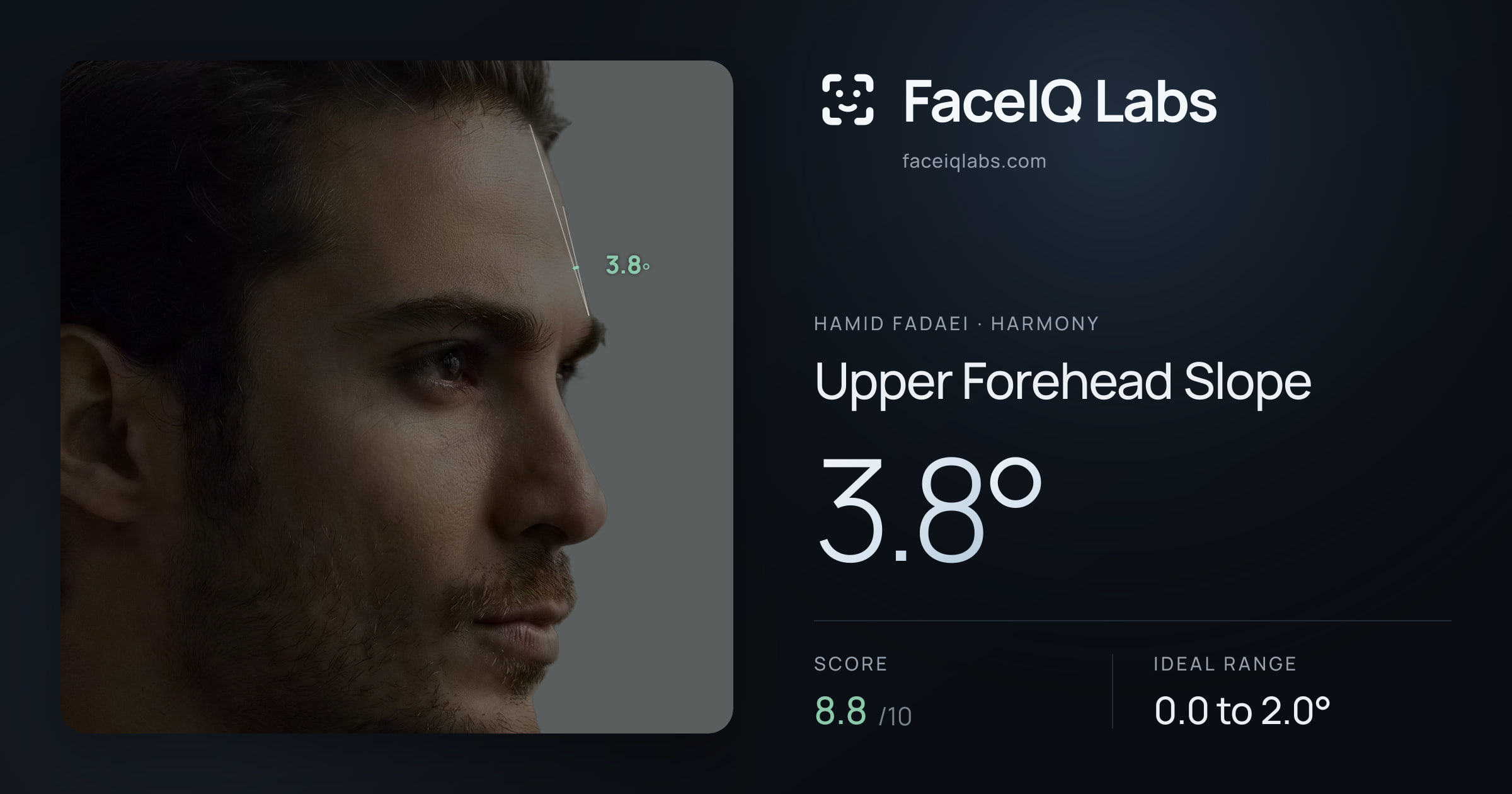 Hamid Fadaei Upper Forehead Slope: 3.8°, drawn on the photo