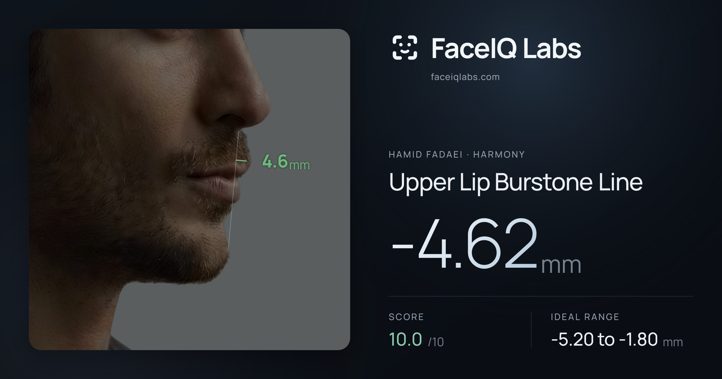 Hamid Fadaei Upper Lip Burstone Line: -4.62mm, drawn on the photo