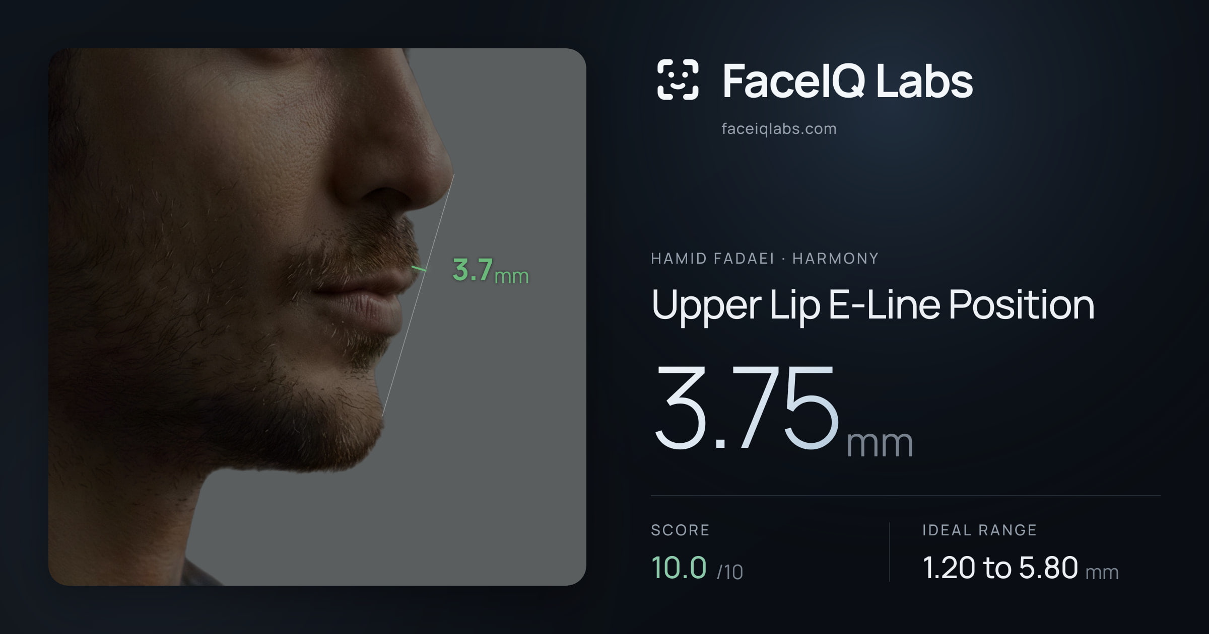 Hamid Fadaei Upper Lip E-Line Position: 3.75mm, drawn on the photo