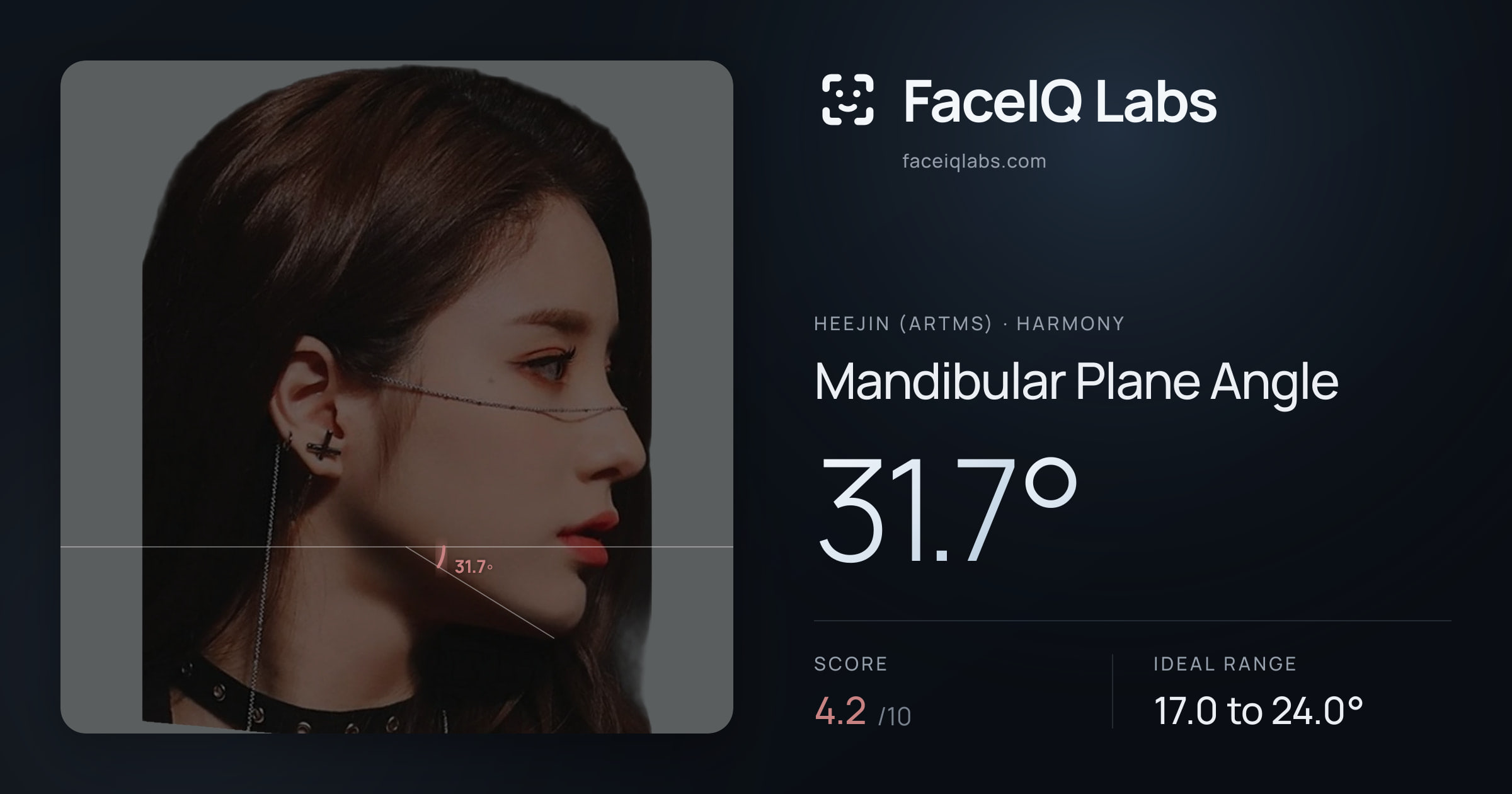 Heejin (ARTMS) Mandibular Plane Angle: 31.7°, drawn on the photo