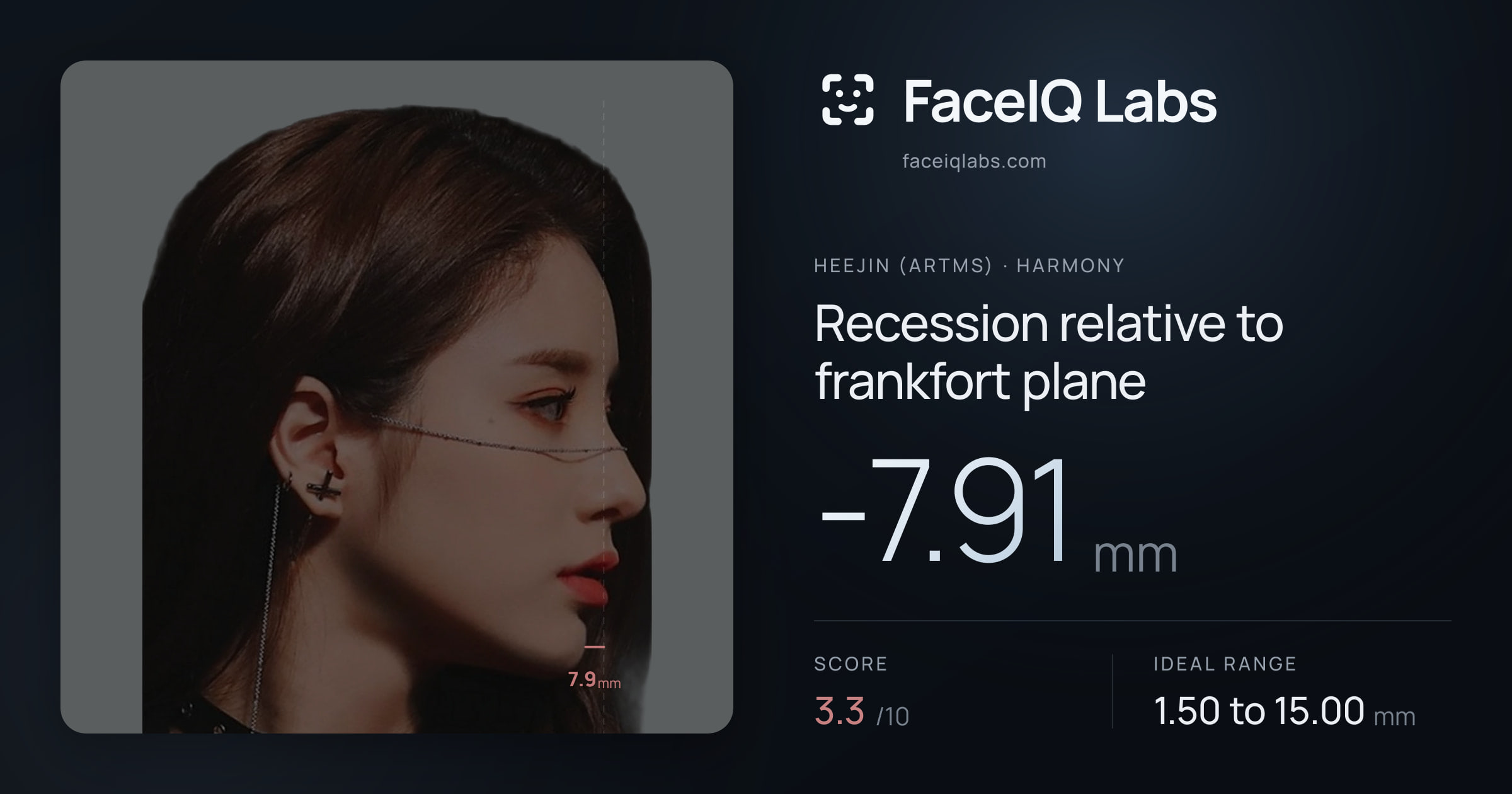 Heejin (ARTMS) Recession relative to frankfort plane: -7.91mm, drawn on the photo