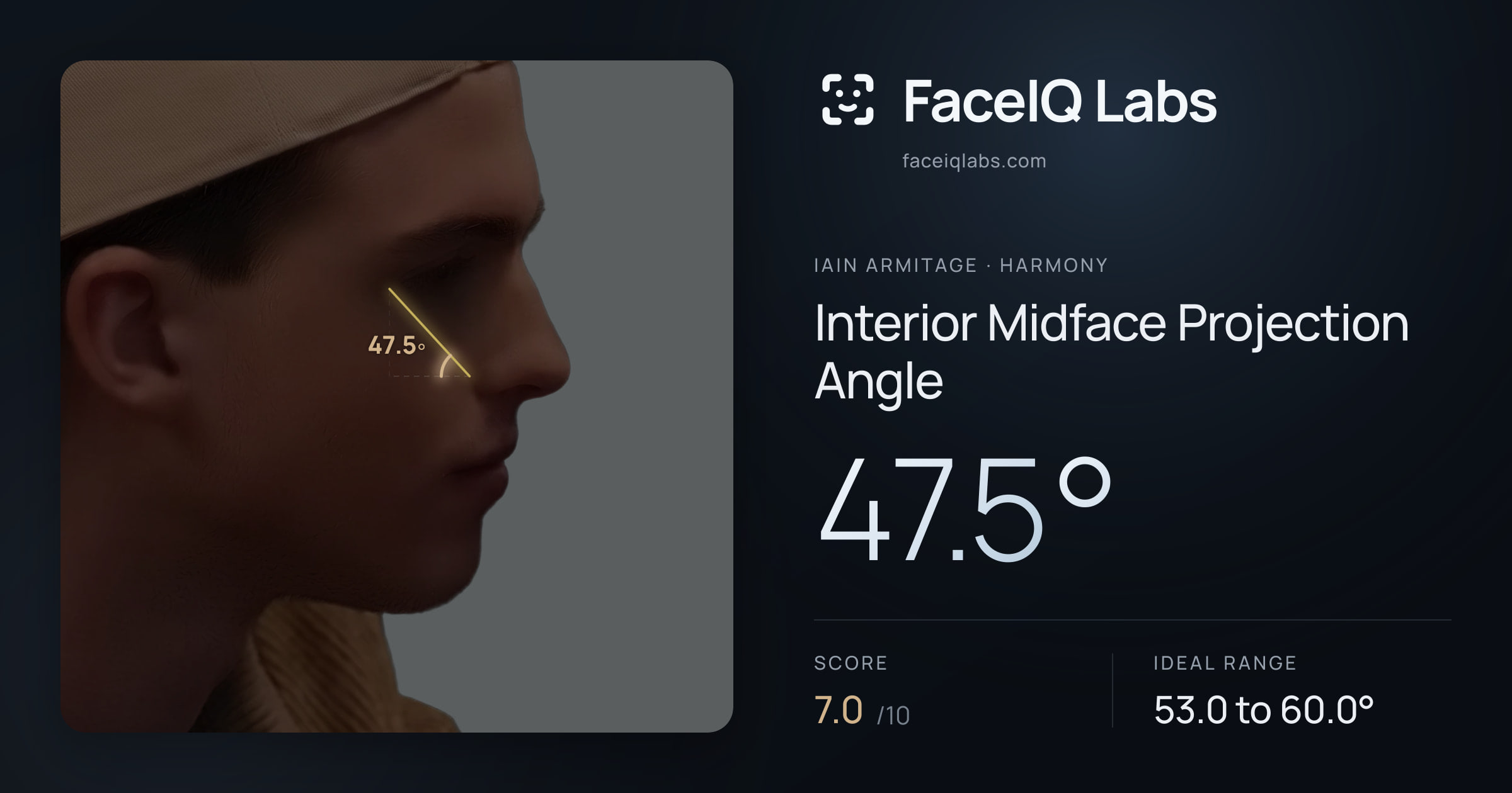 Iain Armitage Interior Midface Projection Angle: 47.5°, drawn on the photo