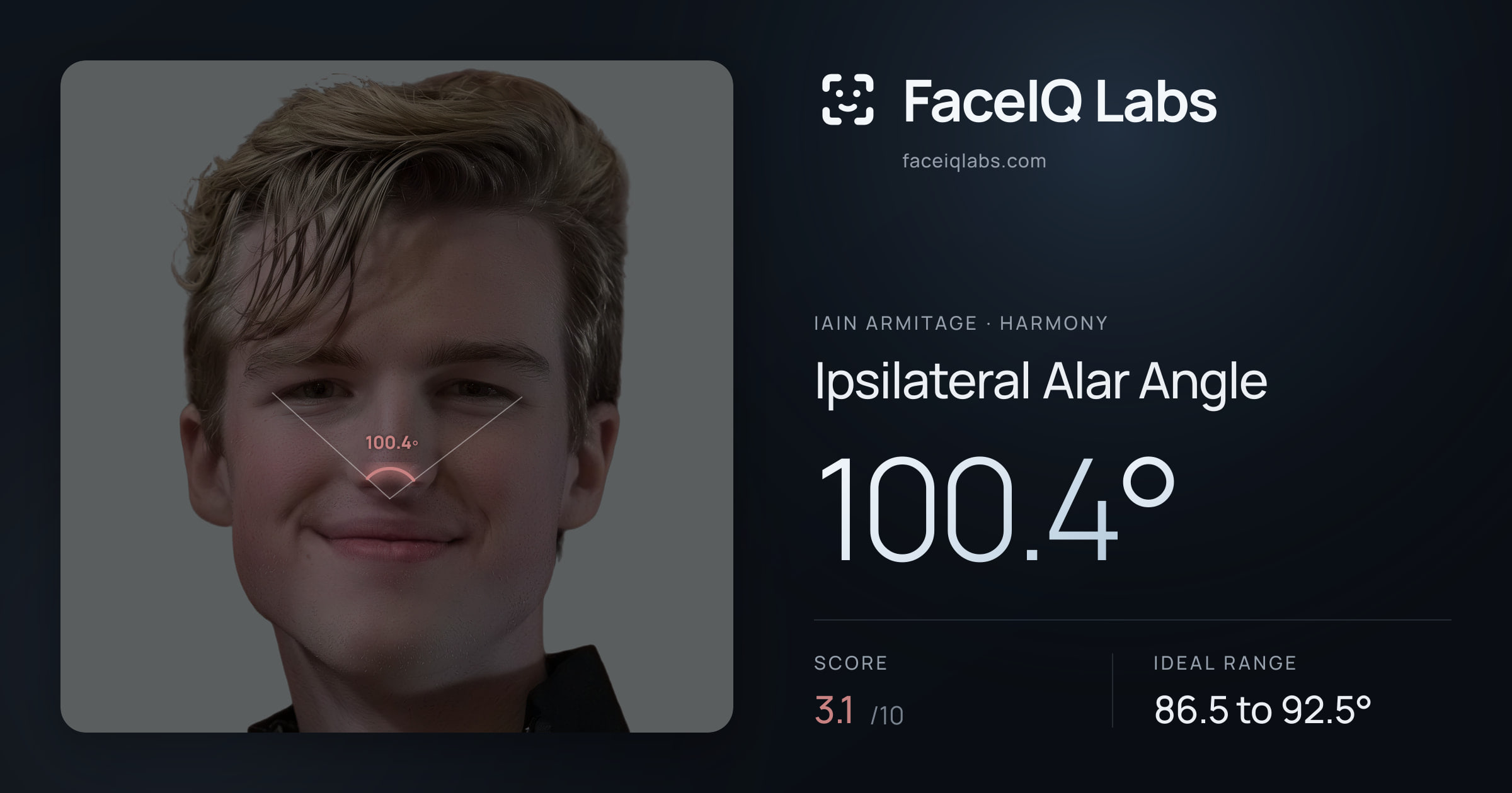 Iain Armitage Ipsilateral Alar Angle: 100.4°, drawn on the photo