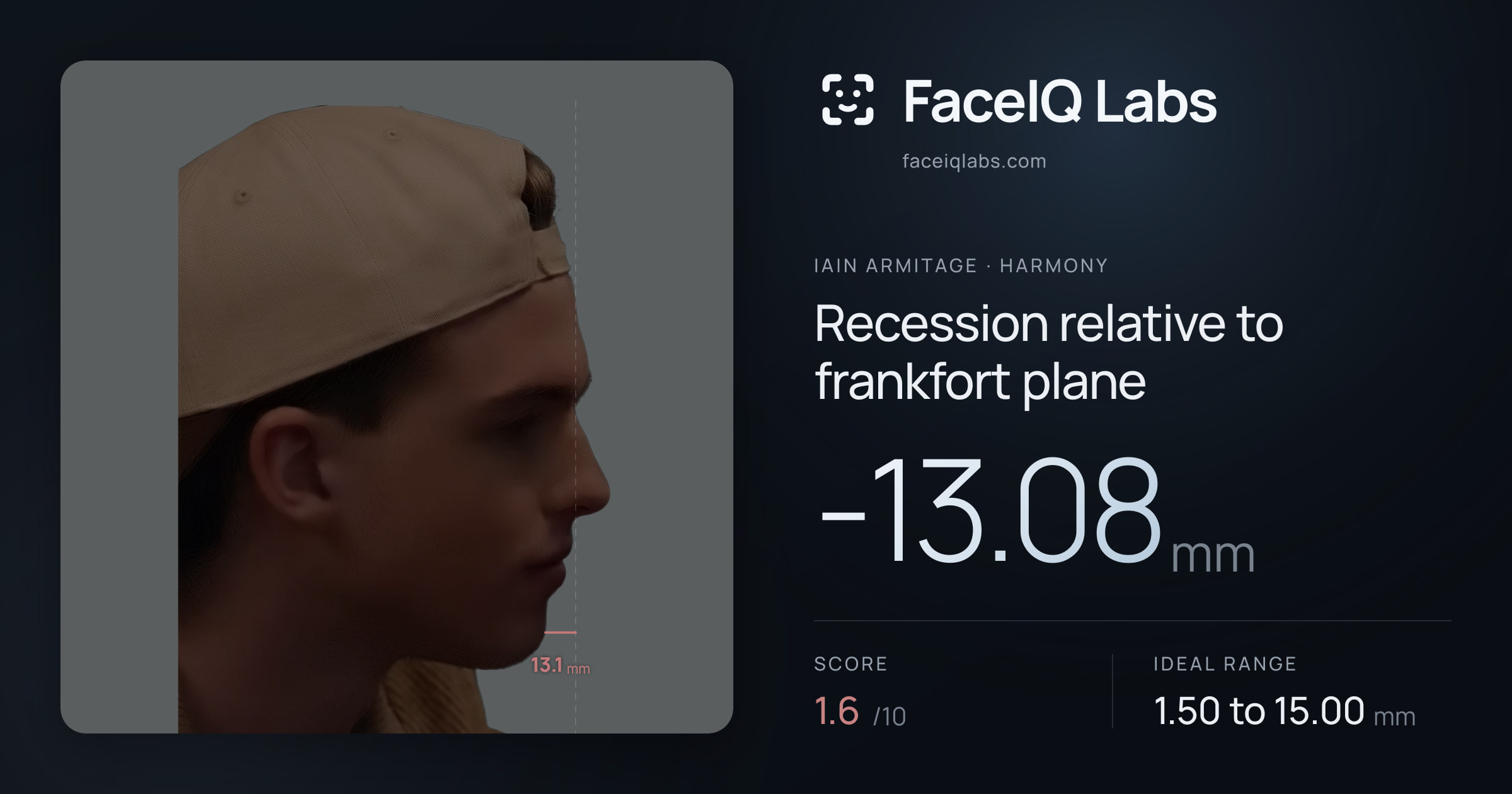 Iain Armitage Recession relative to frankfort plane: -13.08mm, drawn on the photo