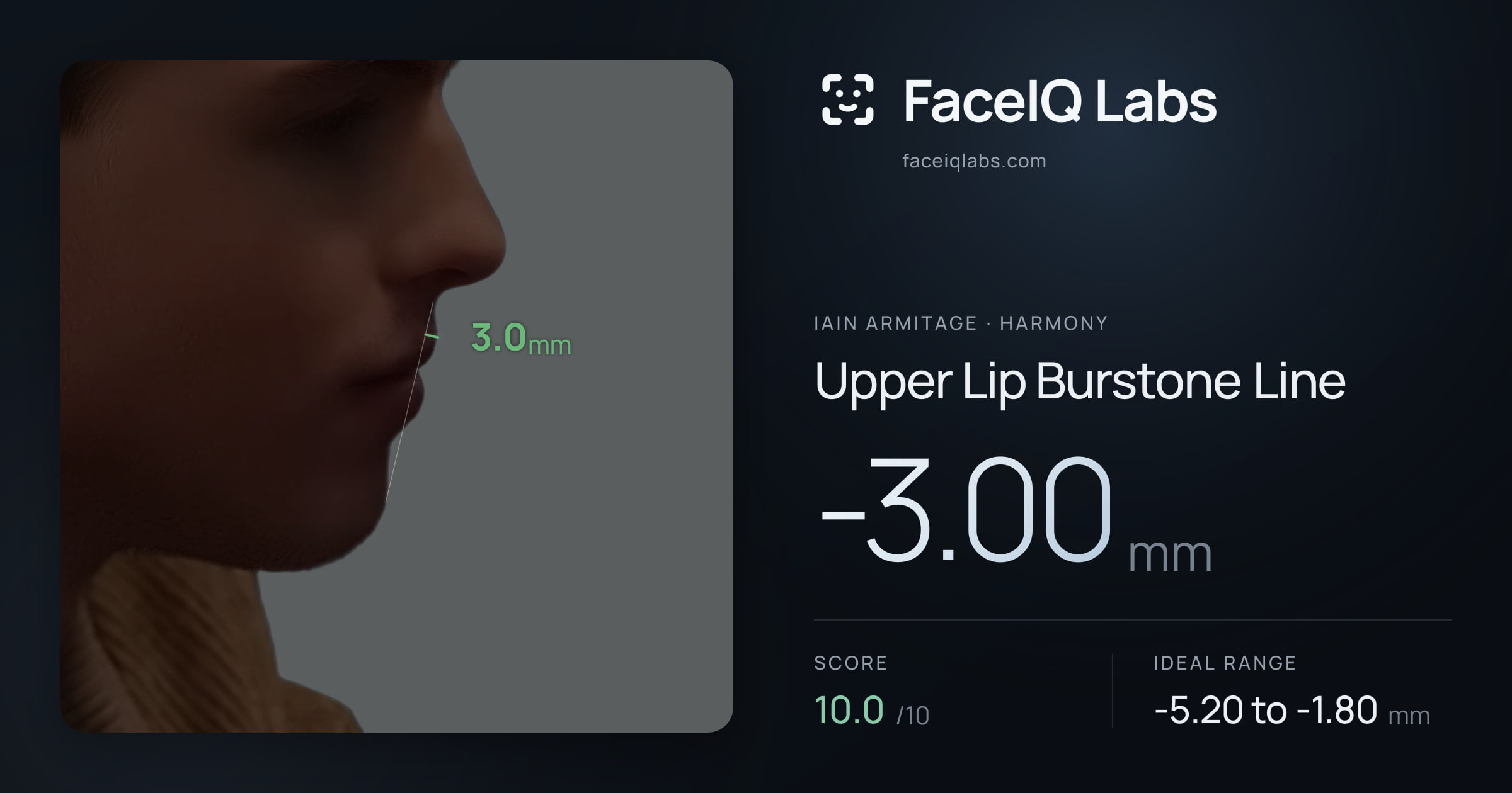 Iain Armitage Upper Lip Burstone Line: -3.00mm, drawn on the photo