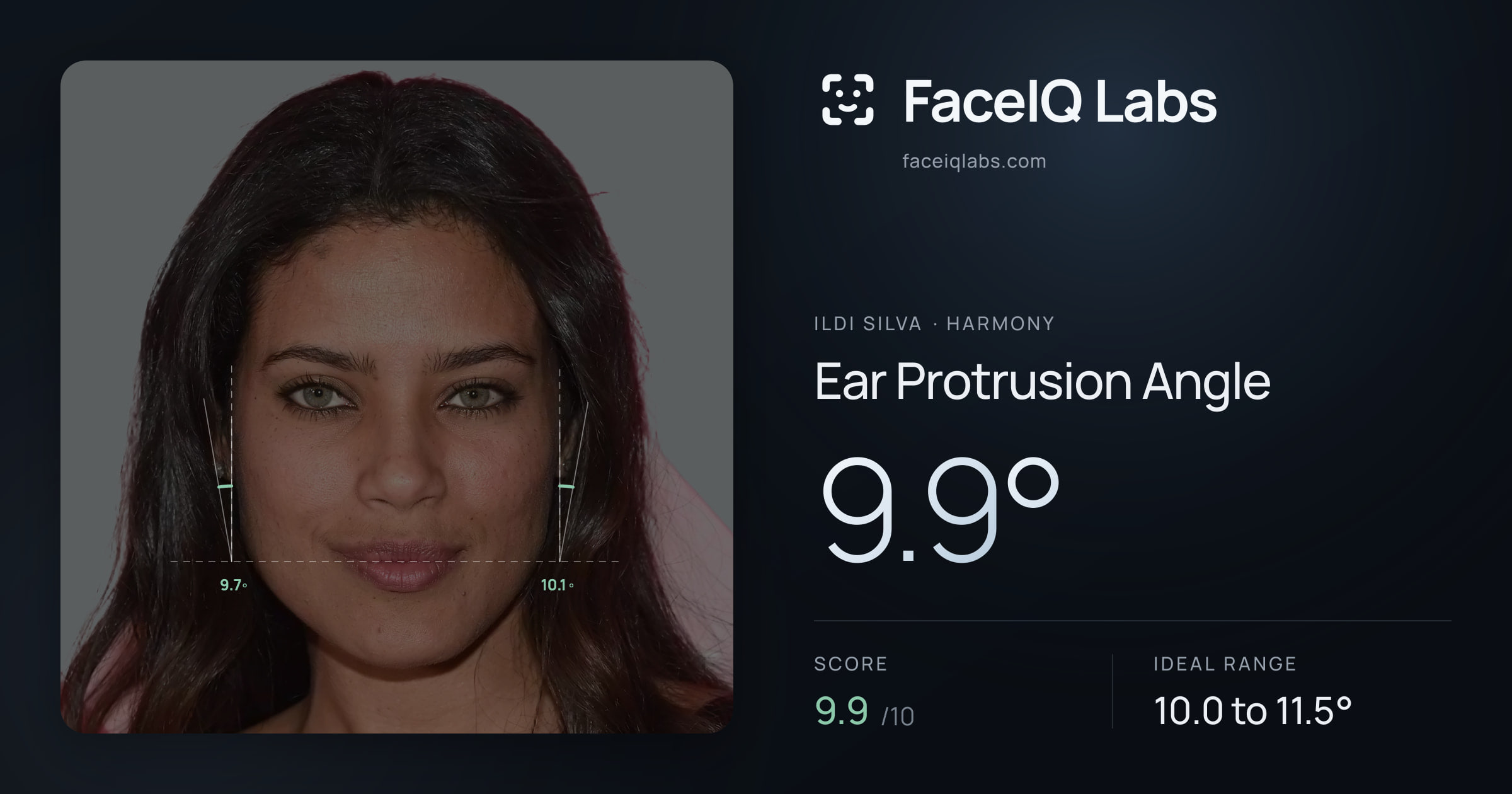 Ildi Silva Ear Protrusion Angle: 9.9°, drawn on the photo