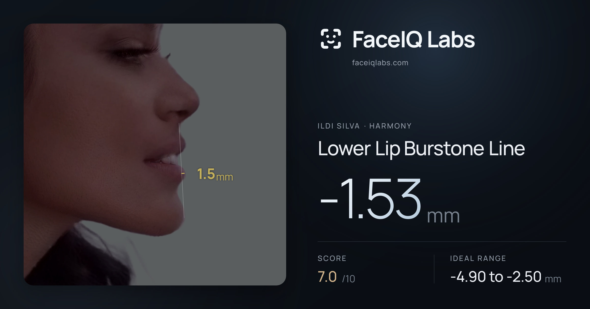 Ildi Silva Lower Lip Burstone Line: -1.53mm, drawn on the photo