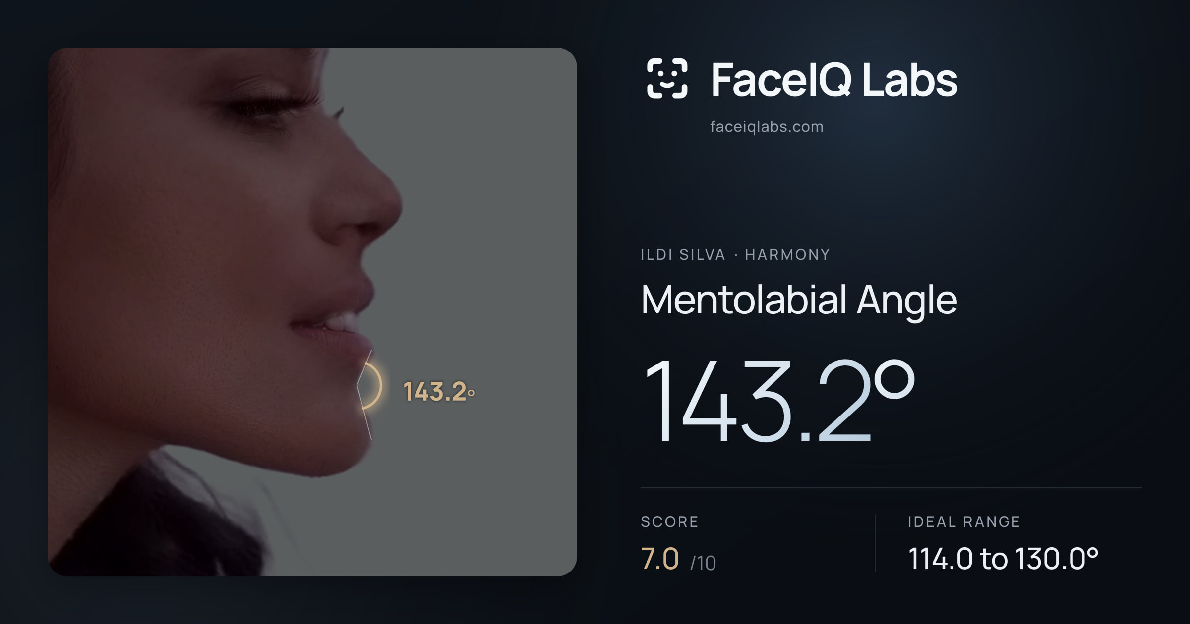 Ildi Silva Mentolabial Angle: 143.2°, drawn on the photo