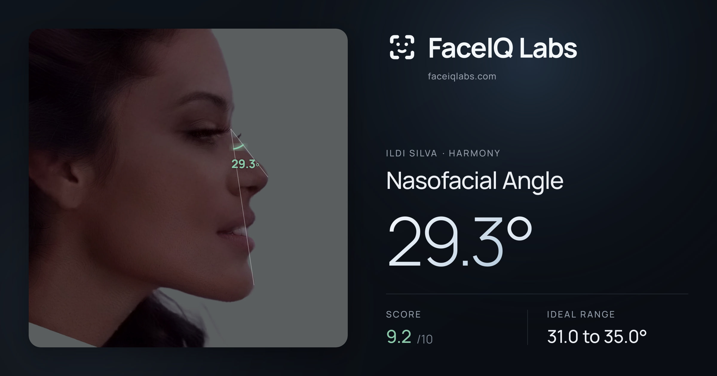 Ildi Silva Nasofacial Angle: 29.3°, drawn on the photo