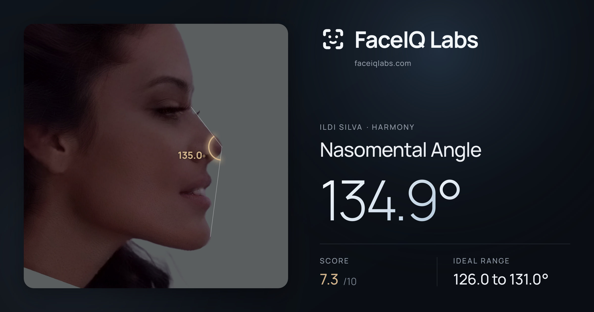 Ildi Silva Nasomental Angle: 134.9°, drawn on the photo