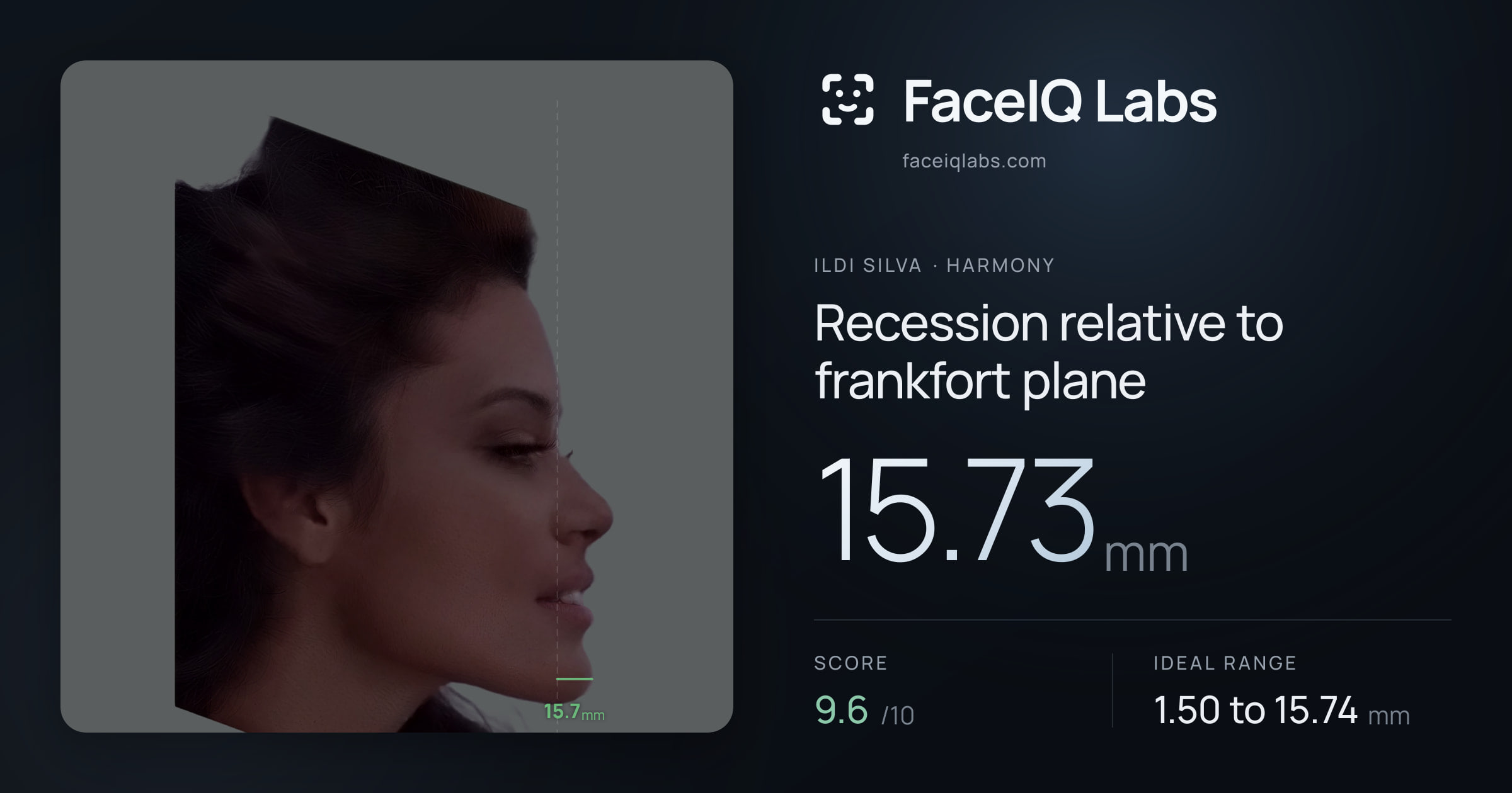 Ildi Silva Recession relative to frankfort plane: 15.73mm, drawn on the photo