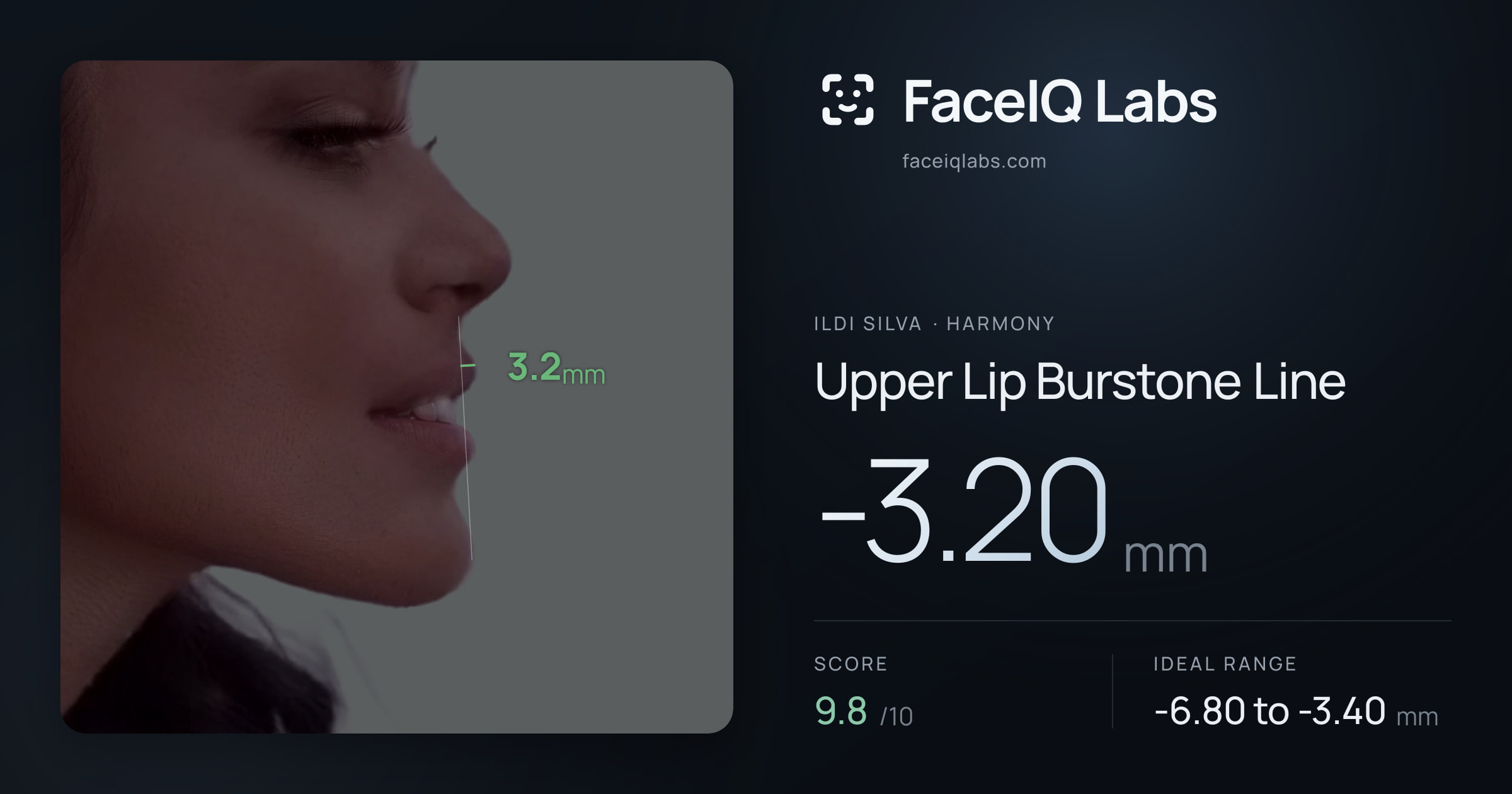 Ildi Silva Upper Lip Burstone Line: -3.20mm, drawn on the photo