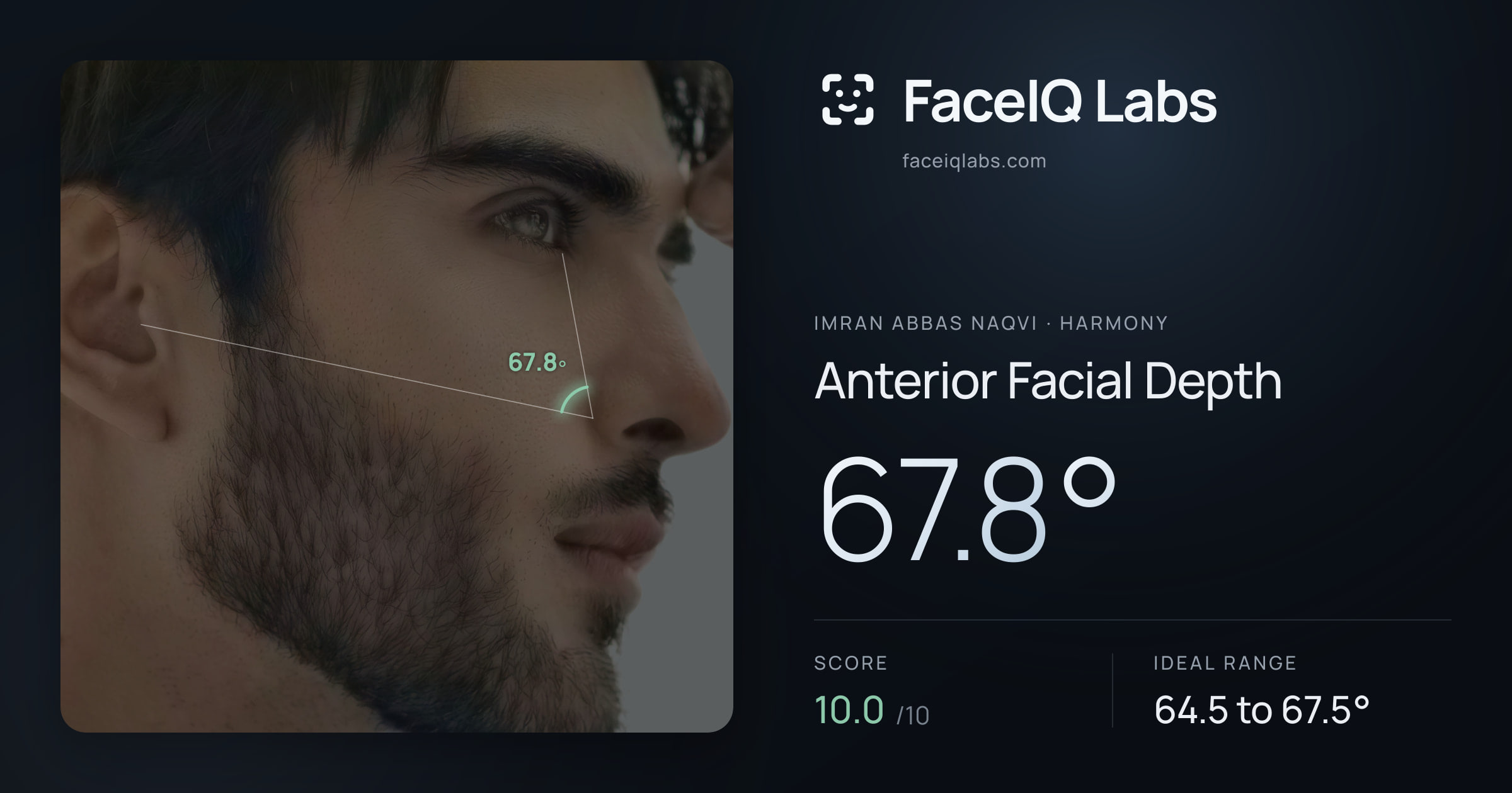 Imran Abbas Naqvi Anterior Facial Depth: 67.8°, drawn on the photo
