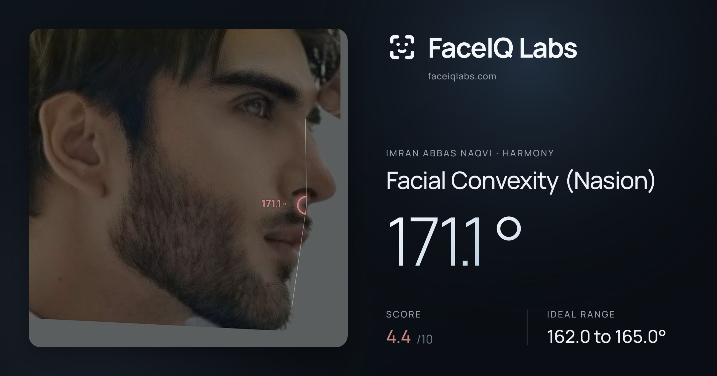 Imran Abbas Naqvi Facial Convexity (Nasion): 171.1°, drawn on the photo