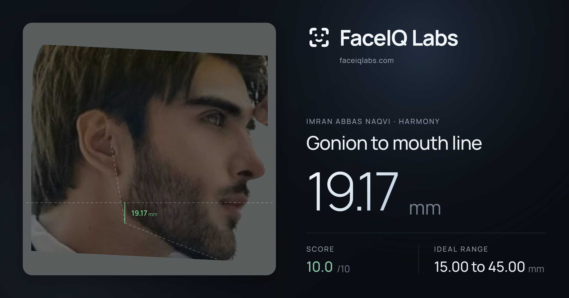 Imran Abbas Naqvi Gonion to mouth line: 19.17mm, drawn on the photo