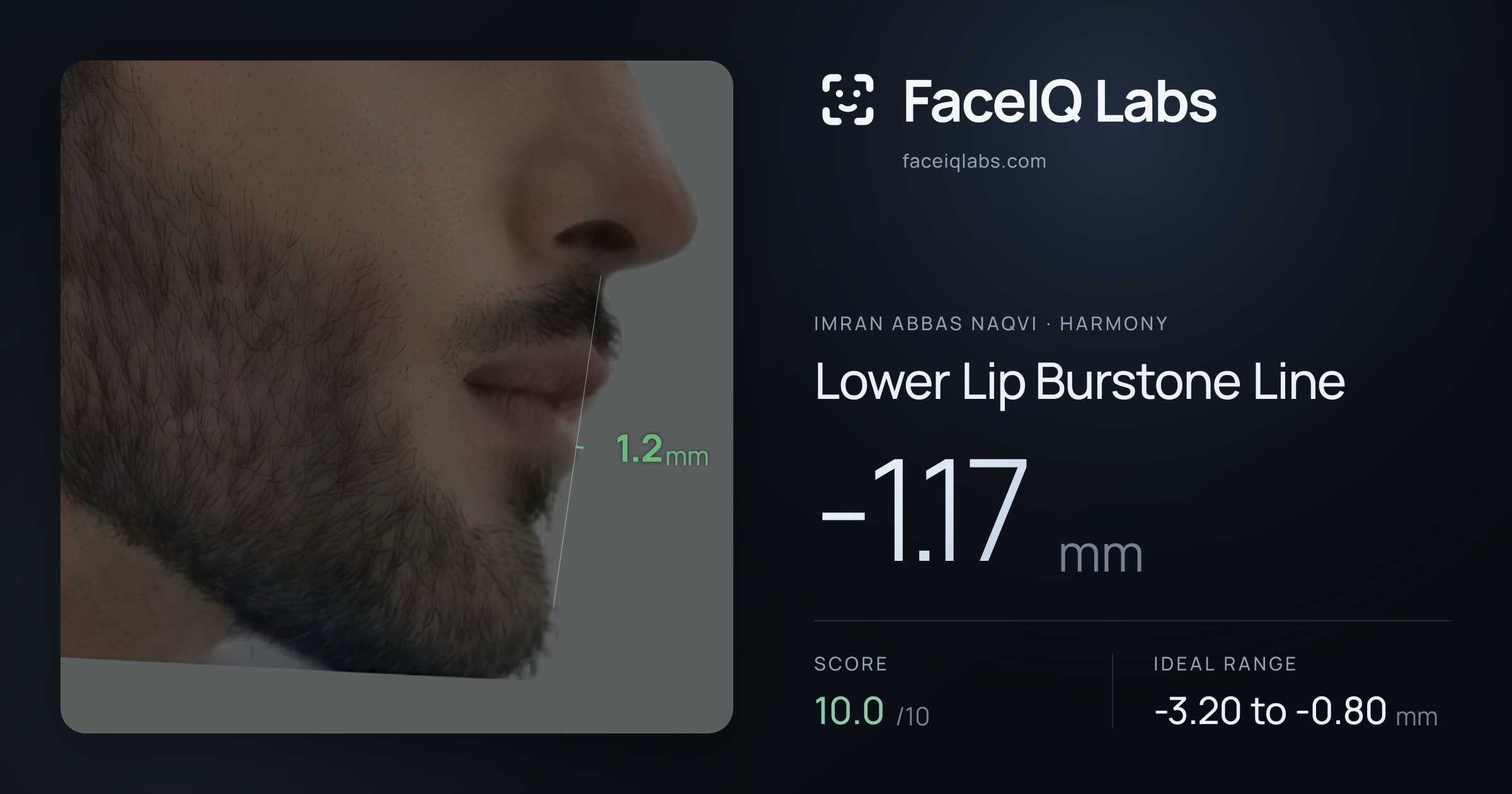 Imran Abbas Naqvi Lower Lip Burstone Line: -1.17mm, drawn on the photo