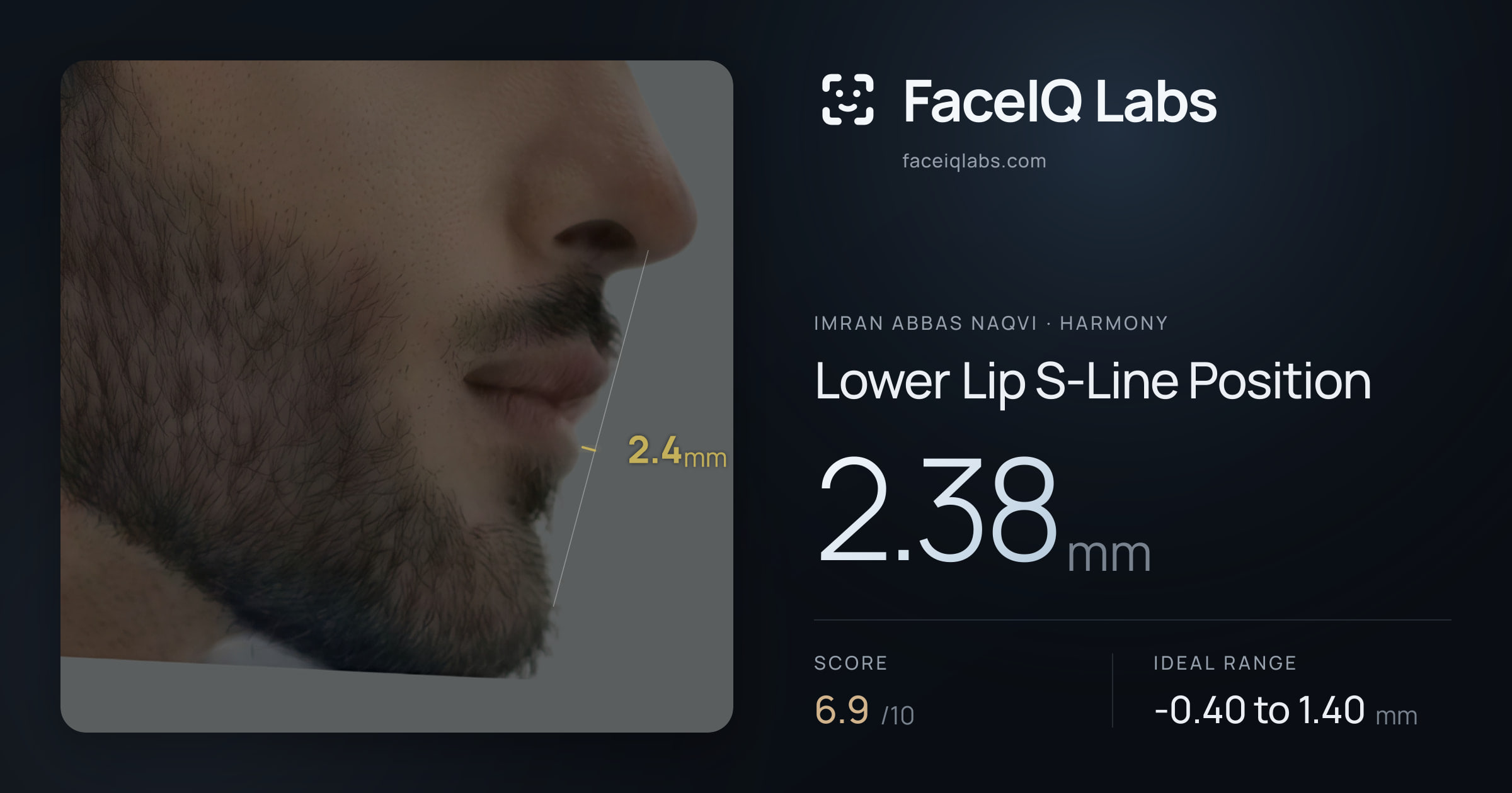 Imran Abbas Naqvi Lower Lip S-Line Position: 2.38mm, drawn on the photo