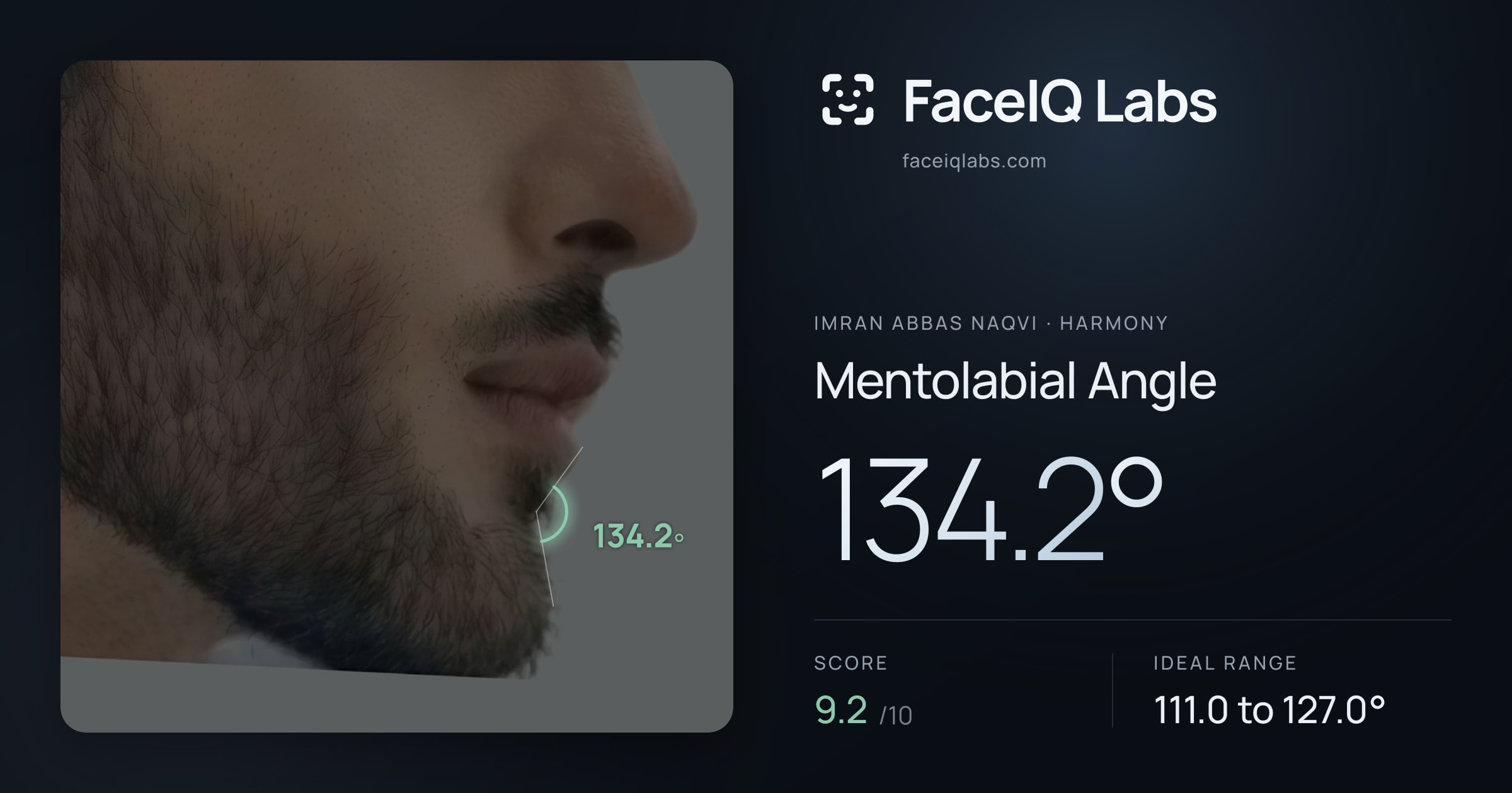Imran Abbas Naqvi Mentolabial Angle: 134.2°, drawn on the photo
