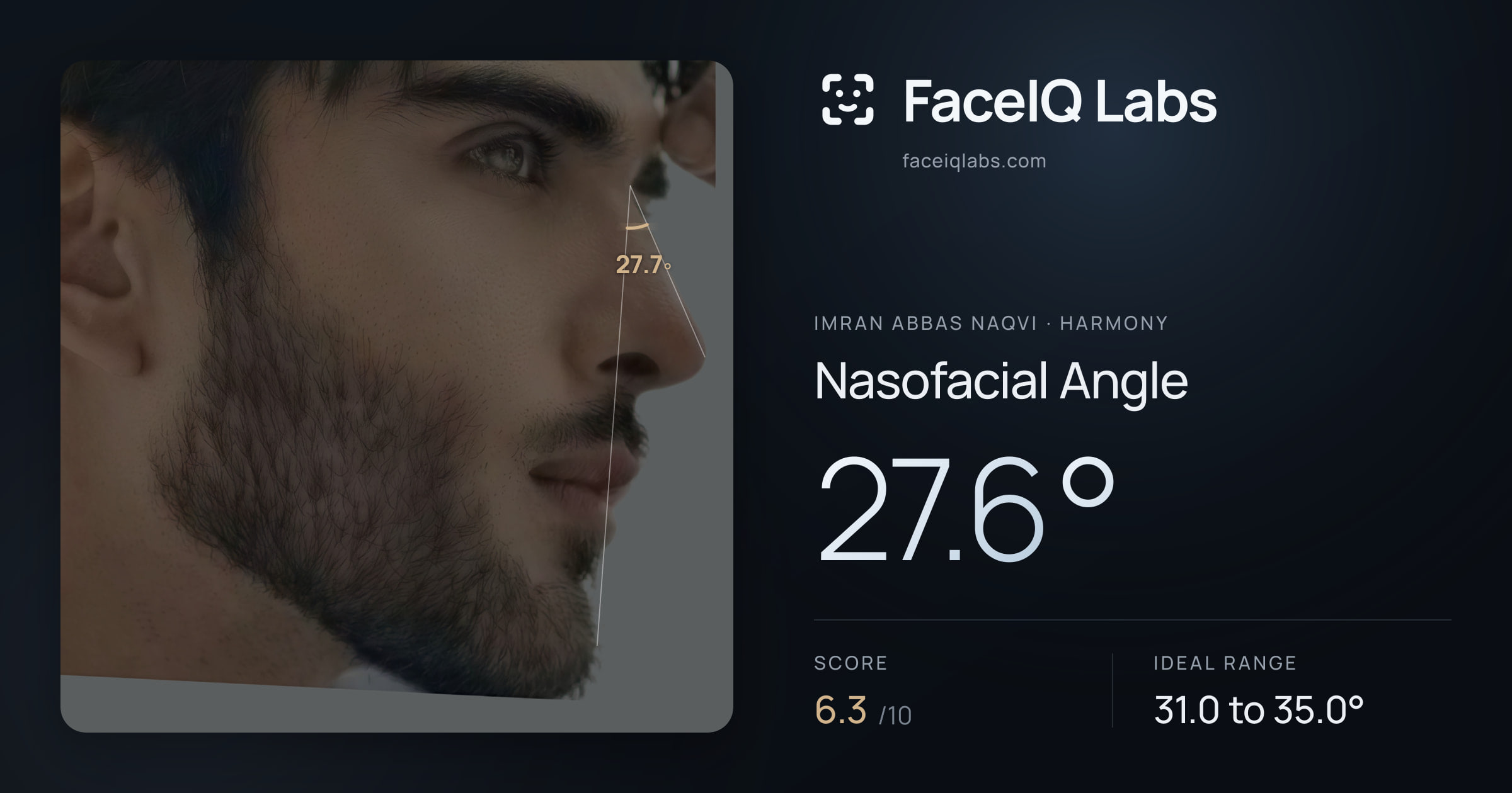 Imran Abbas Naqvi Nasofacial Angle: 27.6°, drawn on the photo