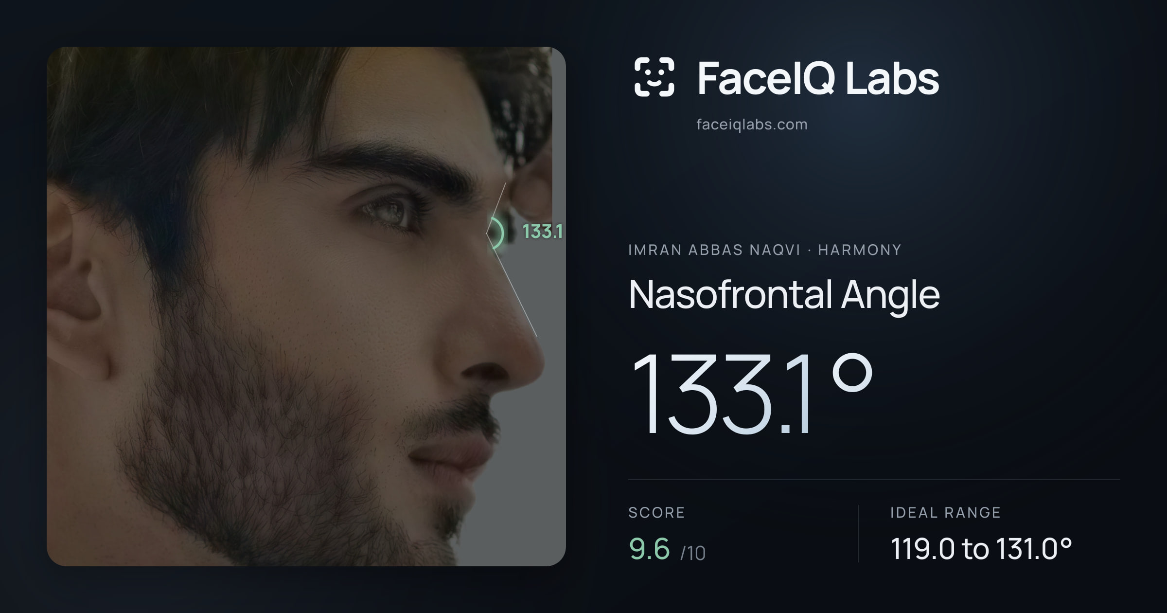 Imran Abbas Naqvi Nasofrontal Angle: 133.1°, drawn on the photo