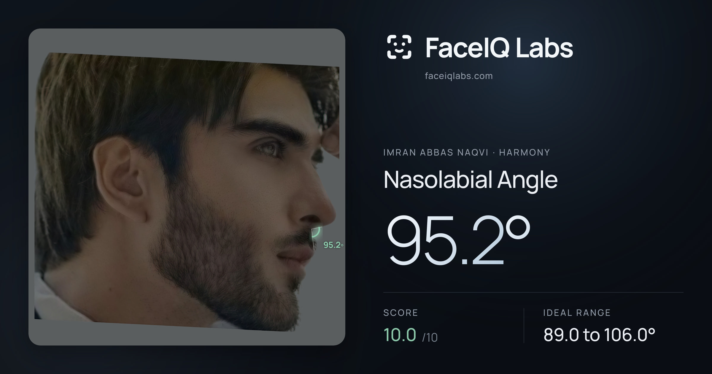Imran Abbas Naqvi Nasolabial Angle: 95.2°, drawn on the photo