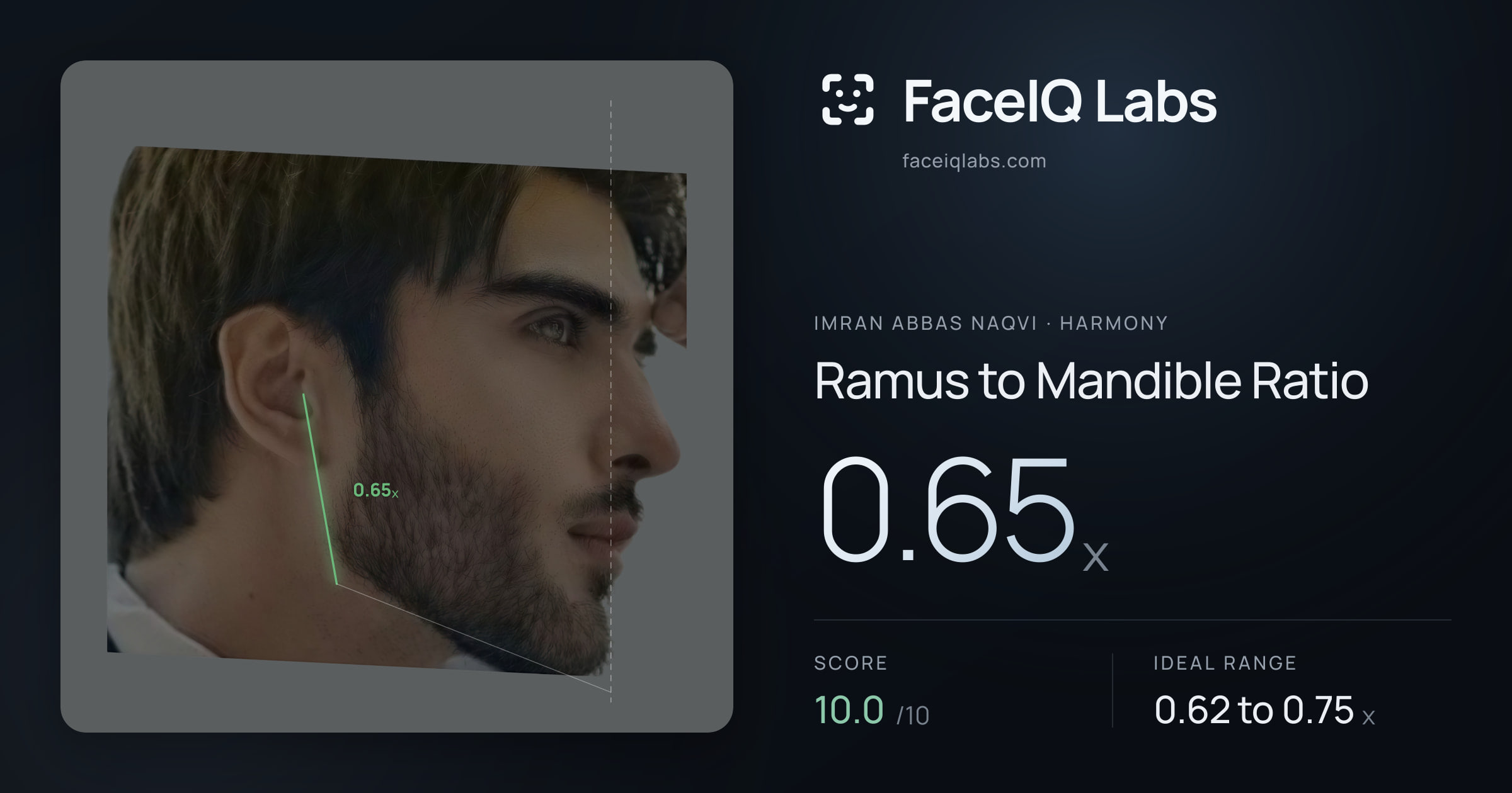 Imran Abbas Naqvi Ramus to Mandible Ratio: 0.65x, drawn on the photo