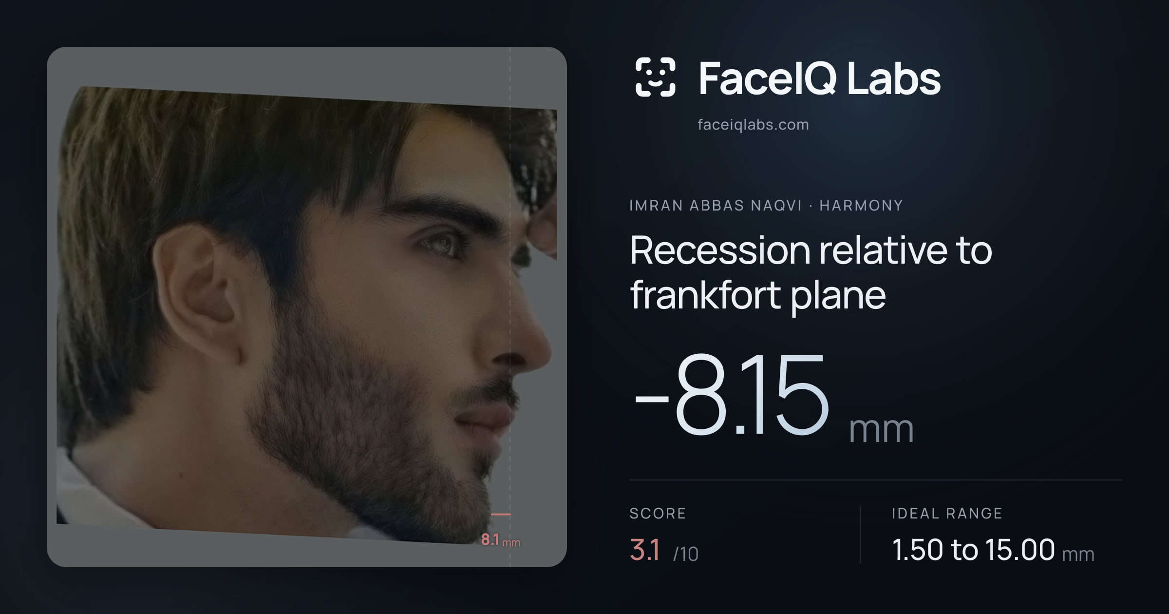 Imran Abbas Naqvi Recession relative to frankfort plane: -8.15mm, drawn on the photo